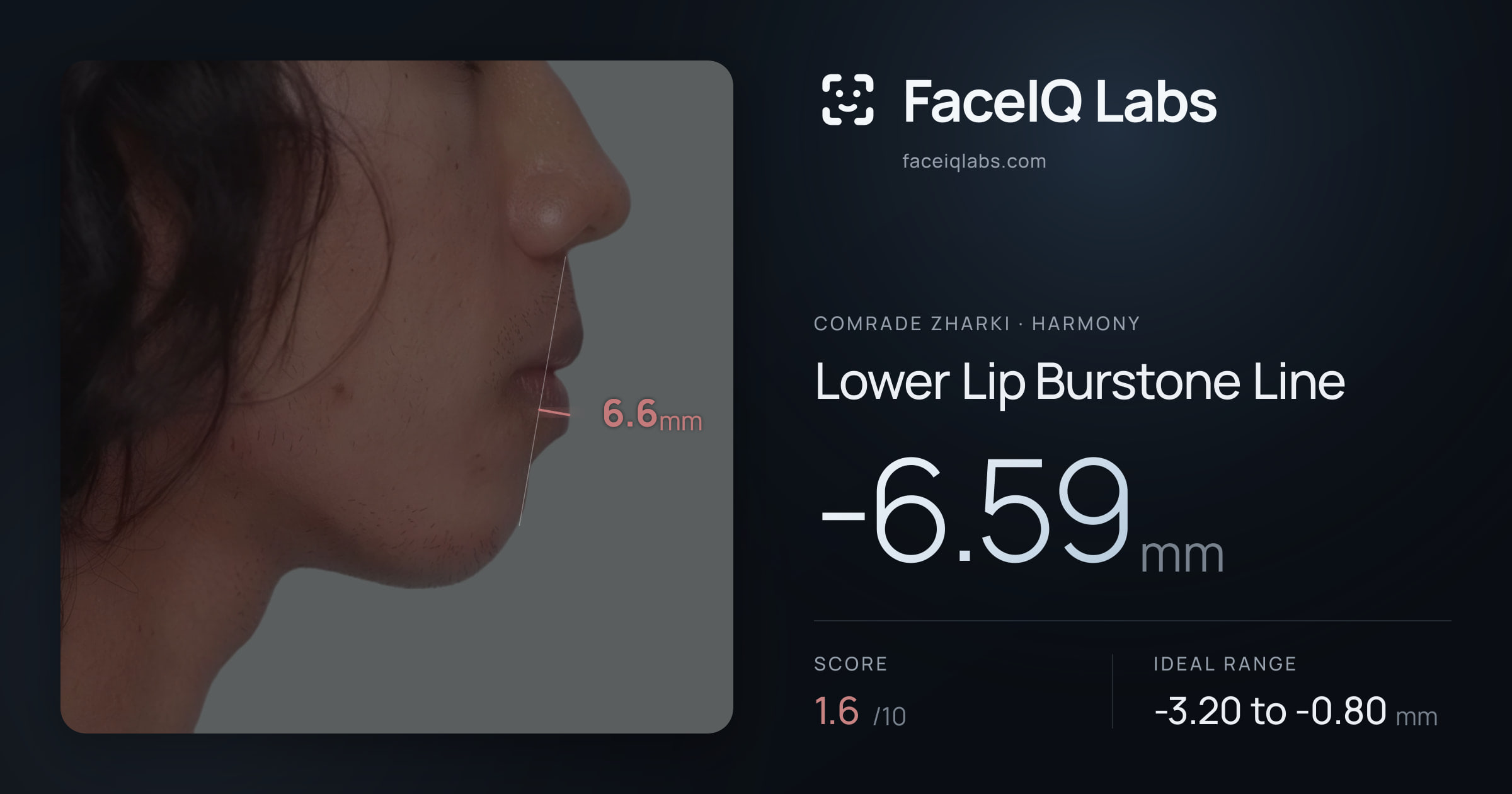 Comrade Zharki Lower Lip Burstone Line: -6.59mm, drawn on the photo
