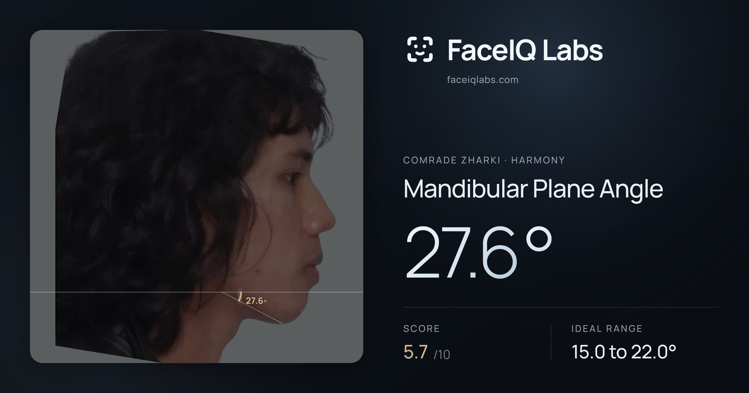 Comrade Zharki Mandibular Plane Angle: 27.6°, drawn on the photo