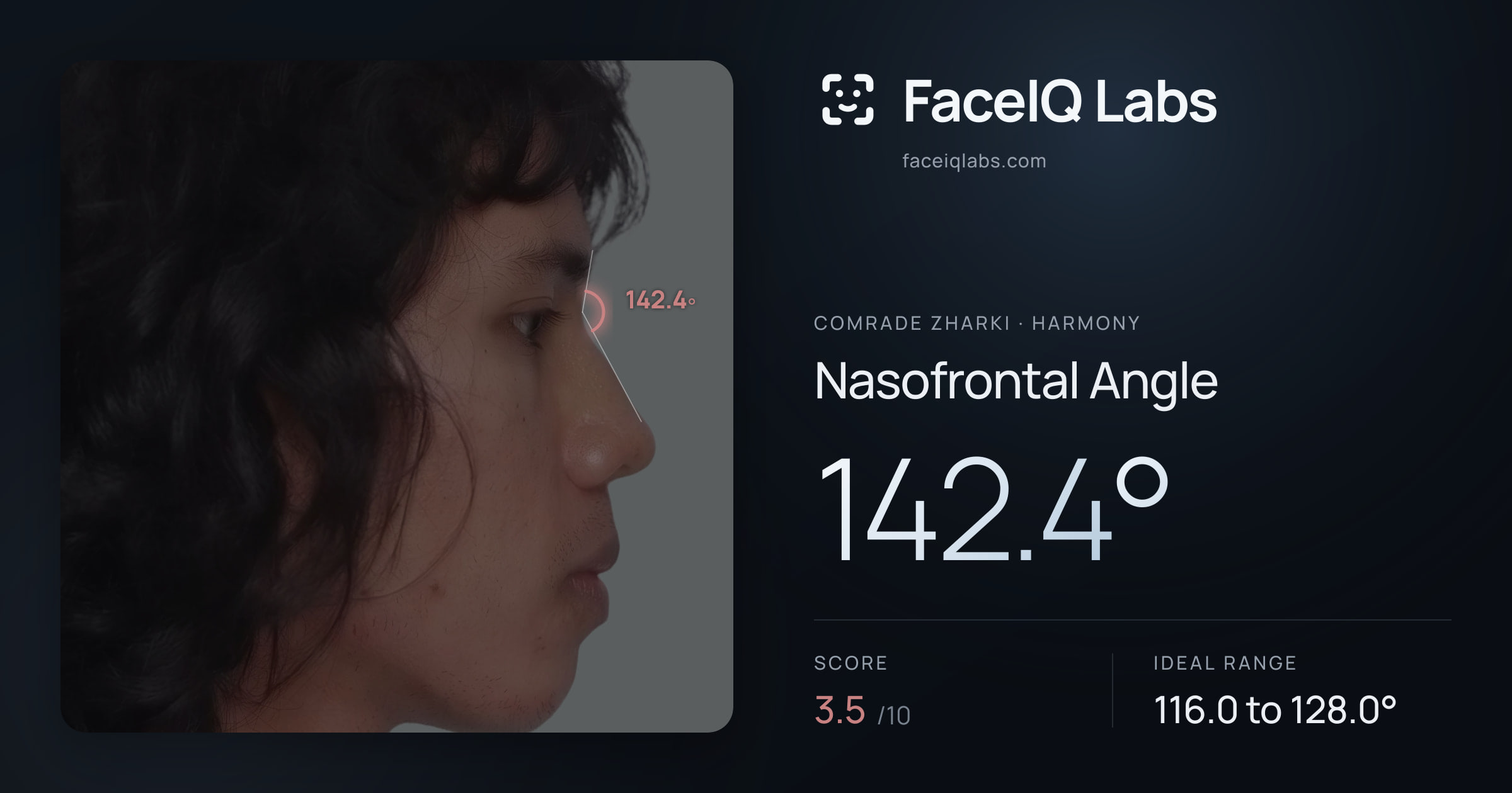 Comrade Zharki Nasofrontal Angle: 142.4°, drawn on the photo