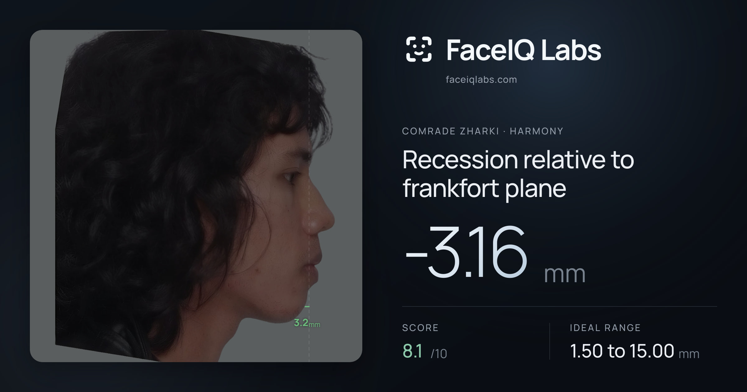 Comrade Zharki Recession relative to frankfort plane: -3.16mm, drawn on the photo