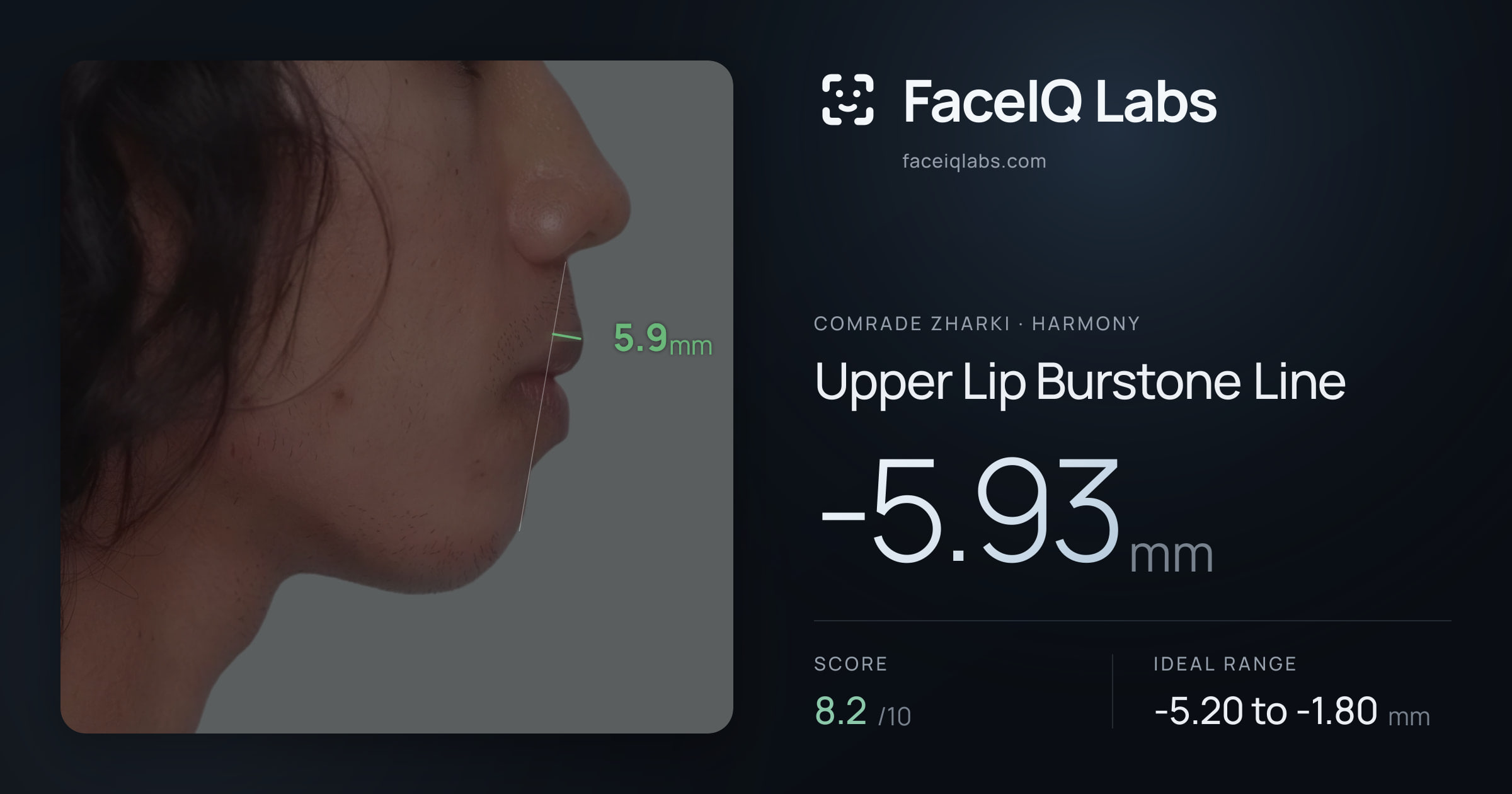 Comrade Zharki Upper Lip Burstone Line: -5.93mm, drawn on the photo