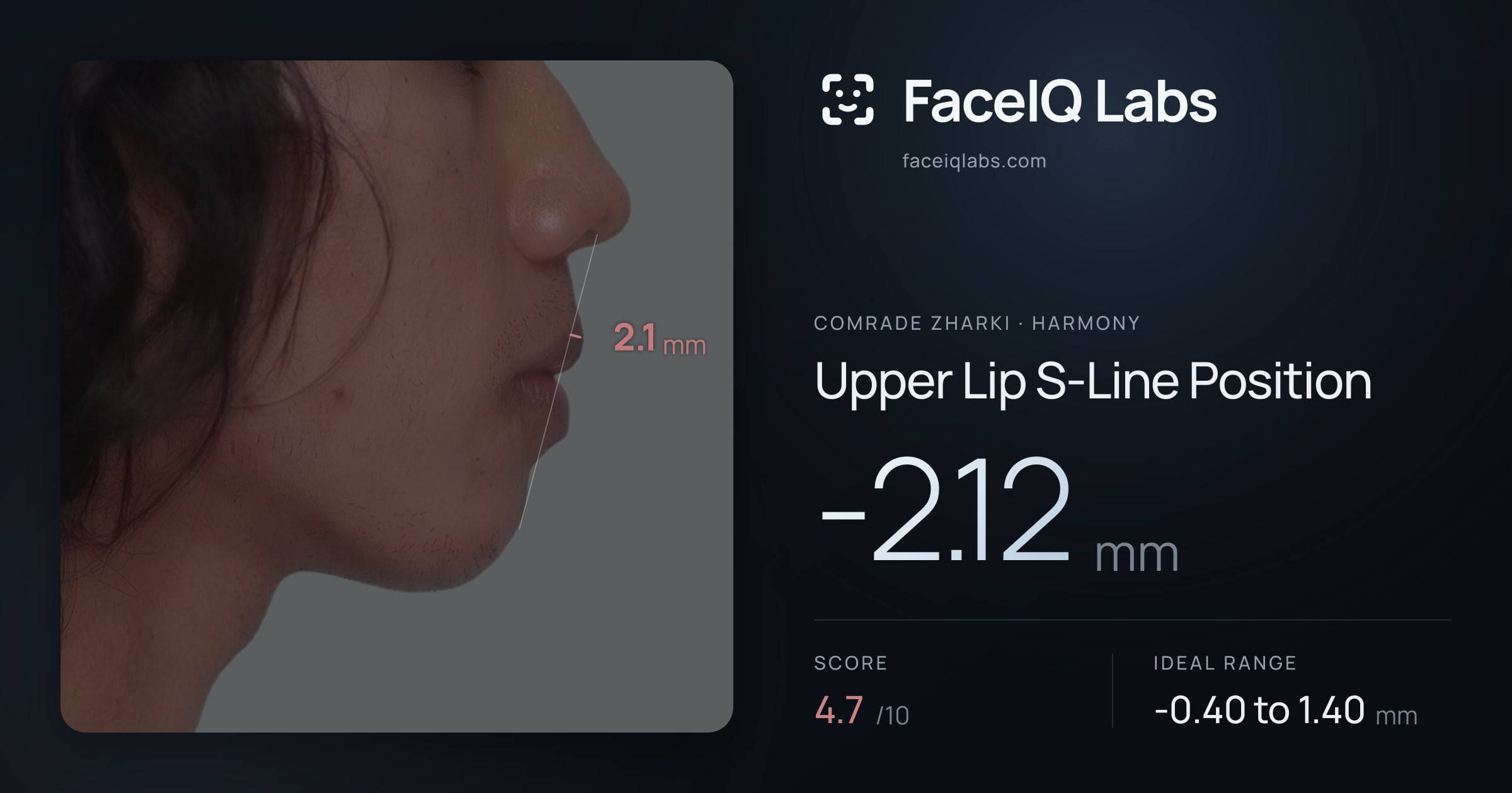 Comrade Zharki Upper Lip S-Line Position: -2.12mm, drawn on the photo
