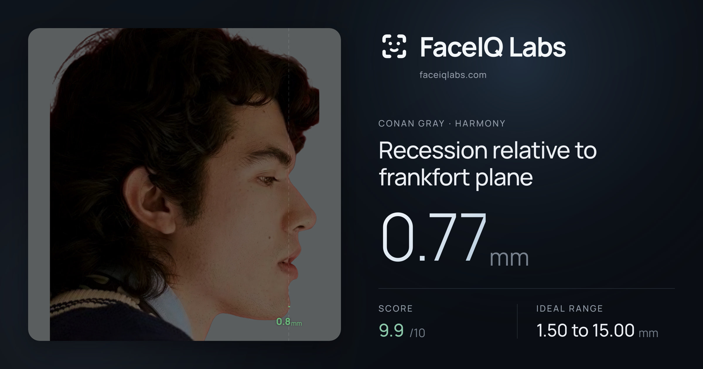 Conan Gray Recession relative to frankfort plane: 0.77mm, drawn on the photo