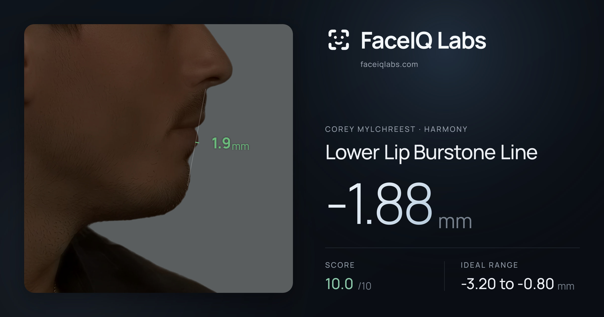 Corey Mylchreest Lower Lip Burstone Line: -1.88mm, drawn on the photo
