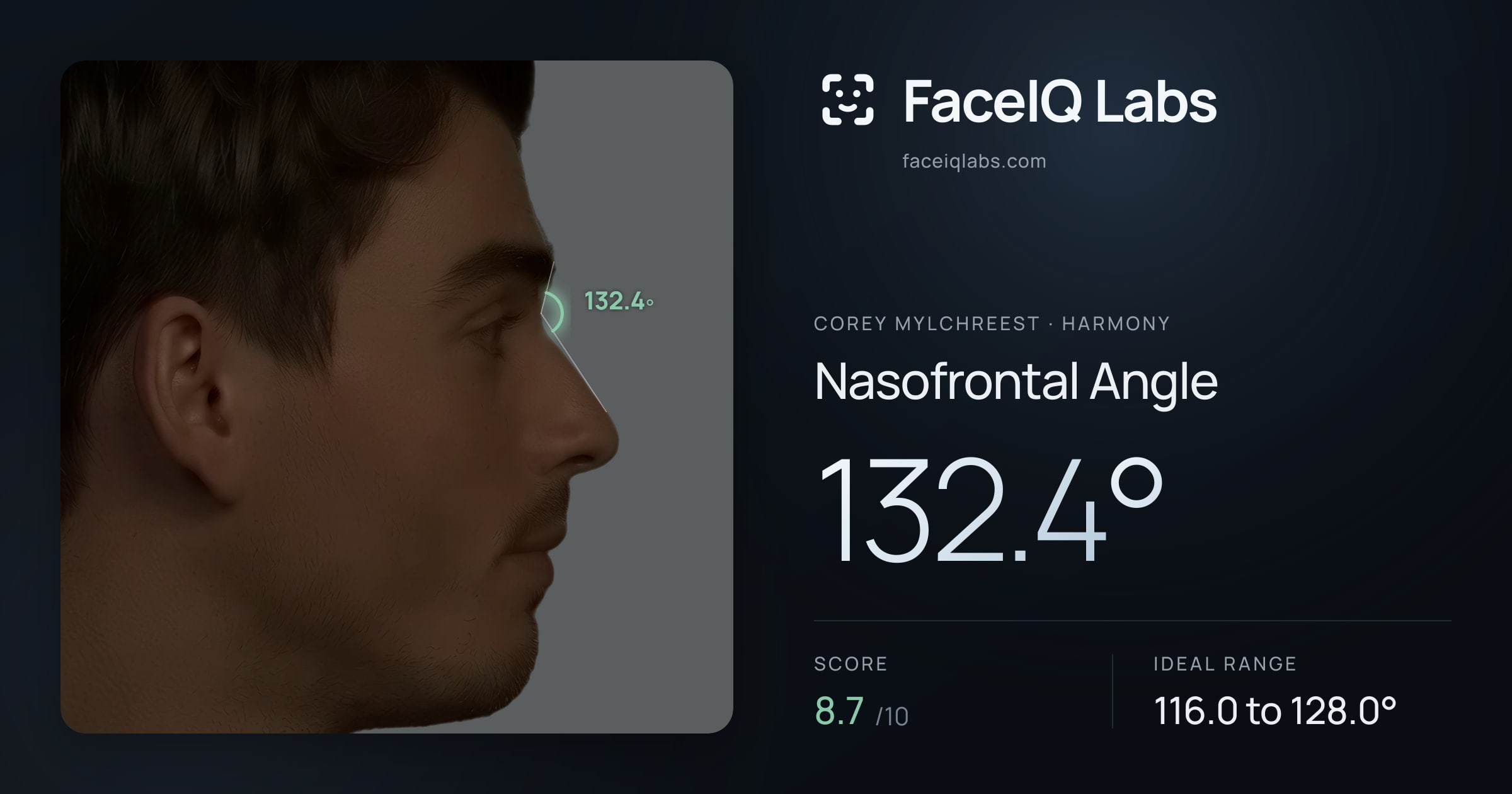 Corey Mylchreest Nasofrontal Angle: 132.4°, drawn on the photo
