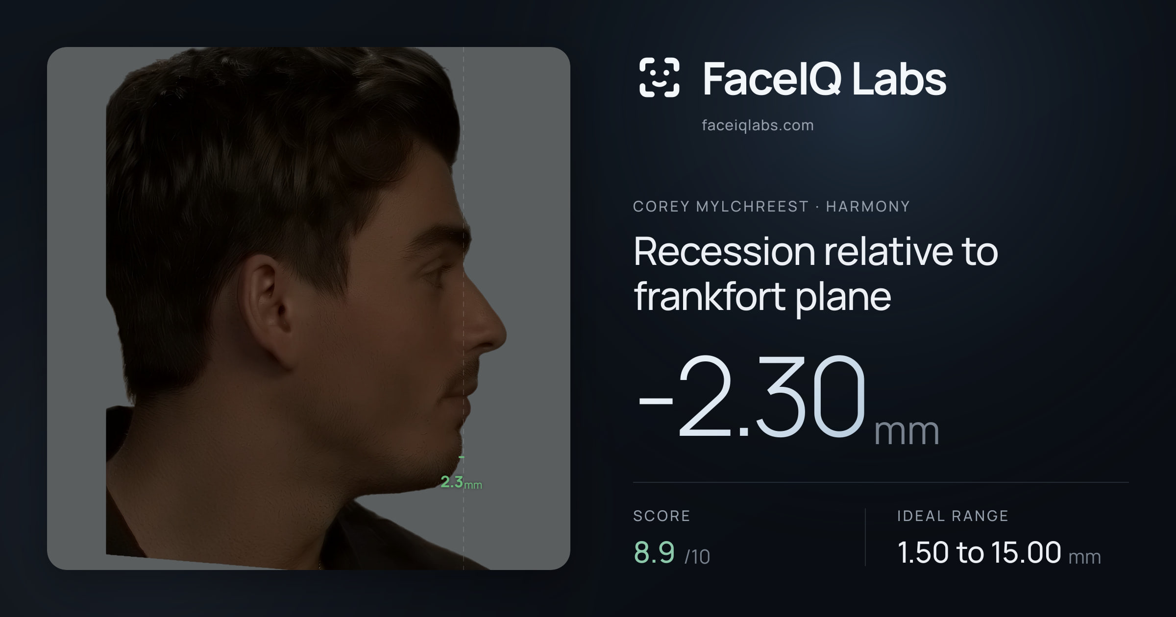 Corey Mylchreest Recession relative to frankfort plane: -2.30mm, drawn on the photo