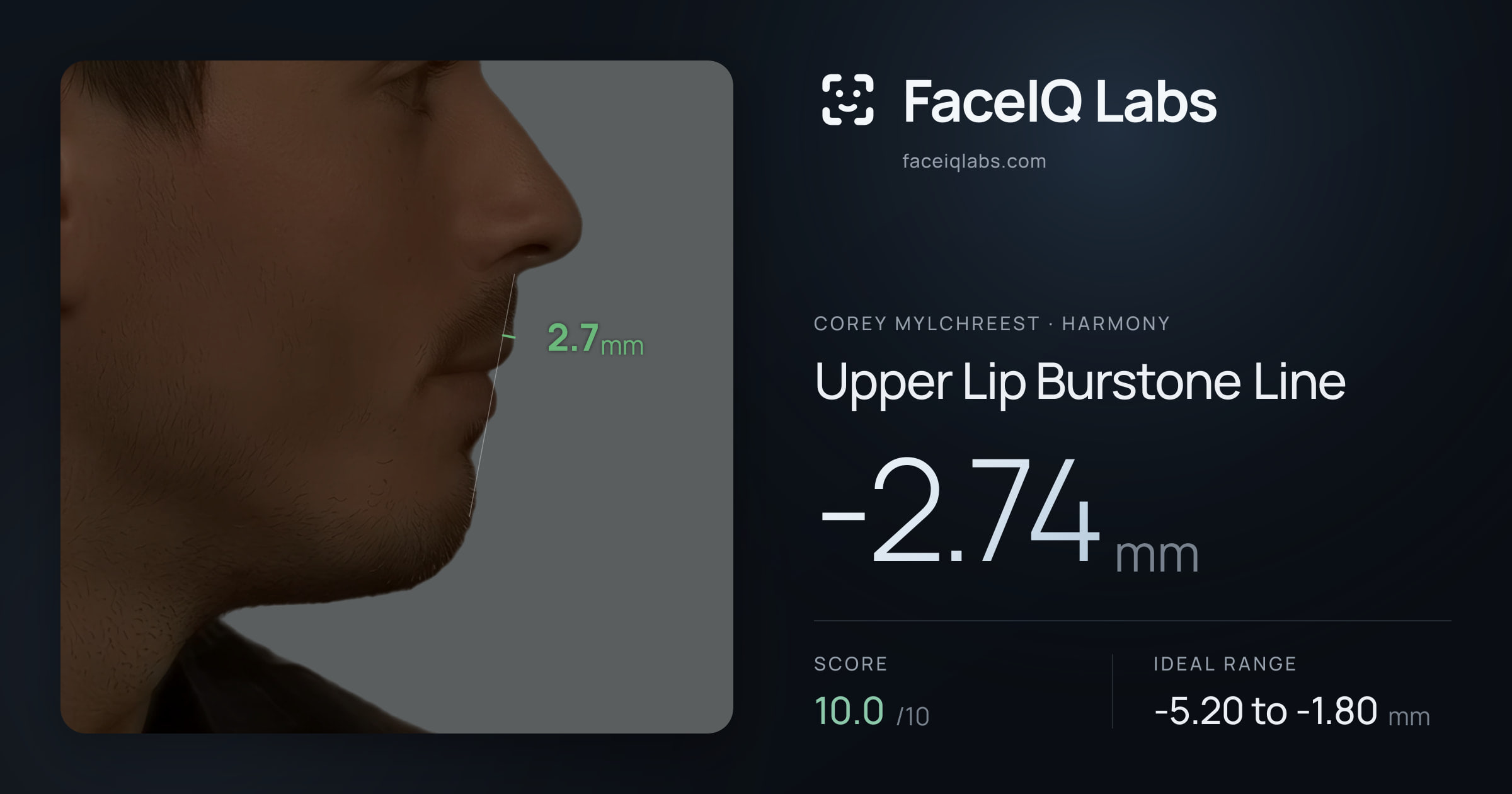Corey Mylchreest Upper Lip Burstone Line: -2.74mm, drawn on the photo