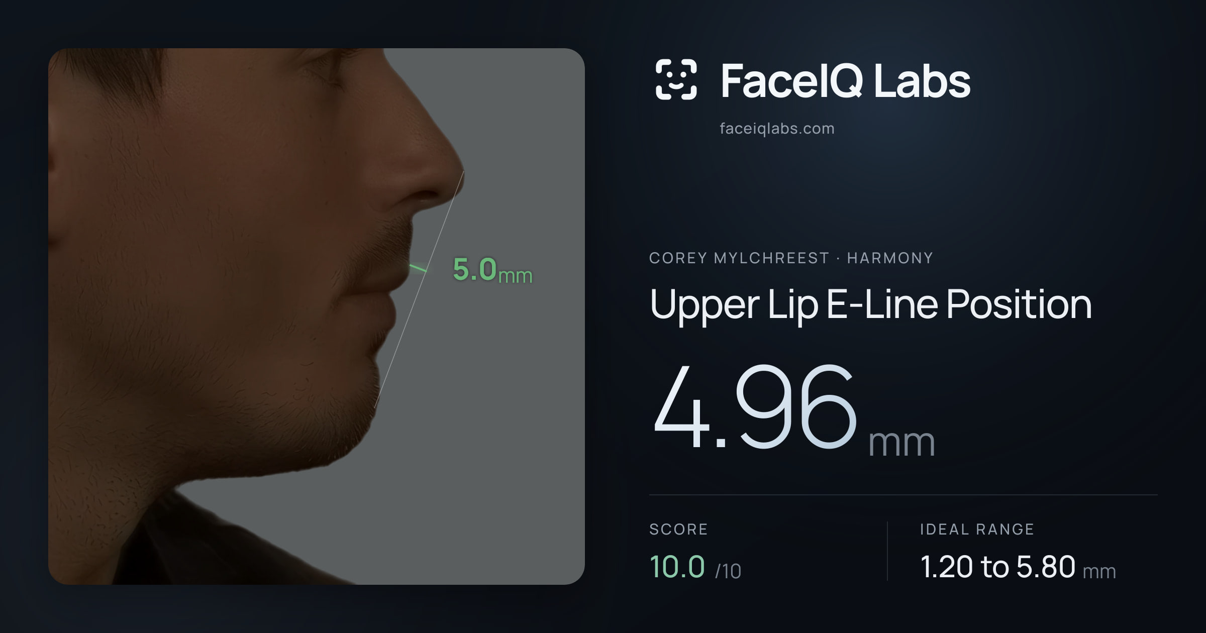 Corey Mylchreest Upper Lip E-Line Position: 4.96mm, drawn on the photo