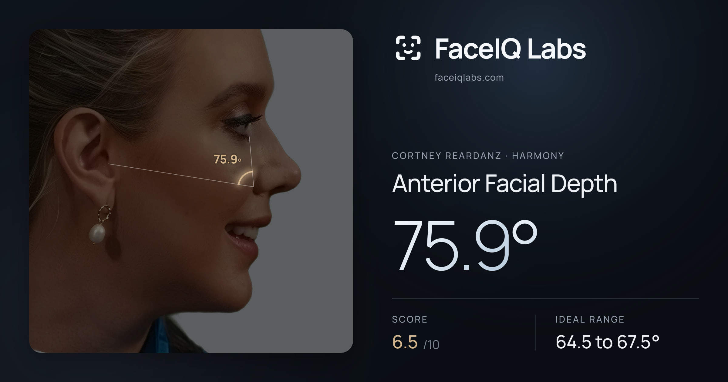 Cortney Reardanz Anterior Facial Depth: 75.9°, drawn on the photo