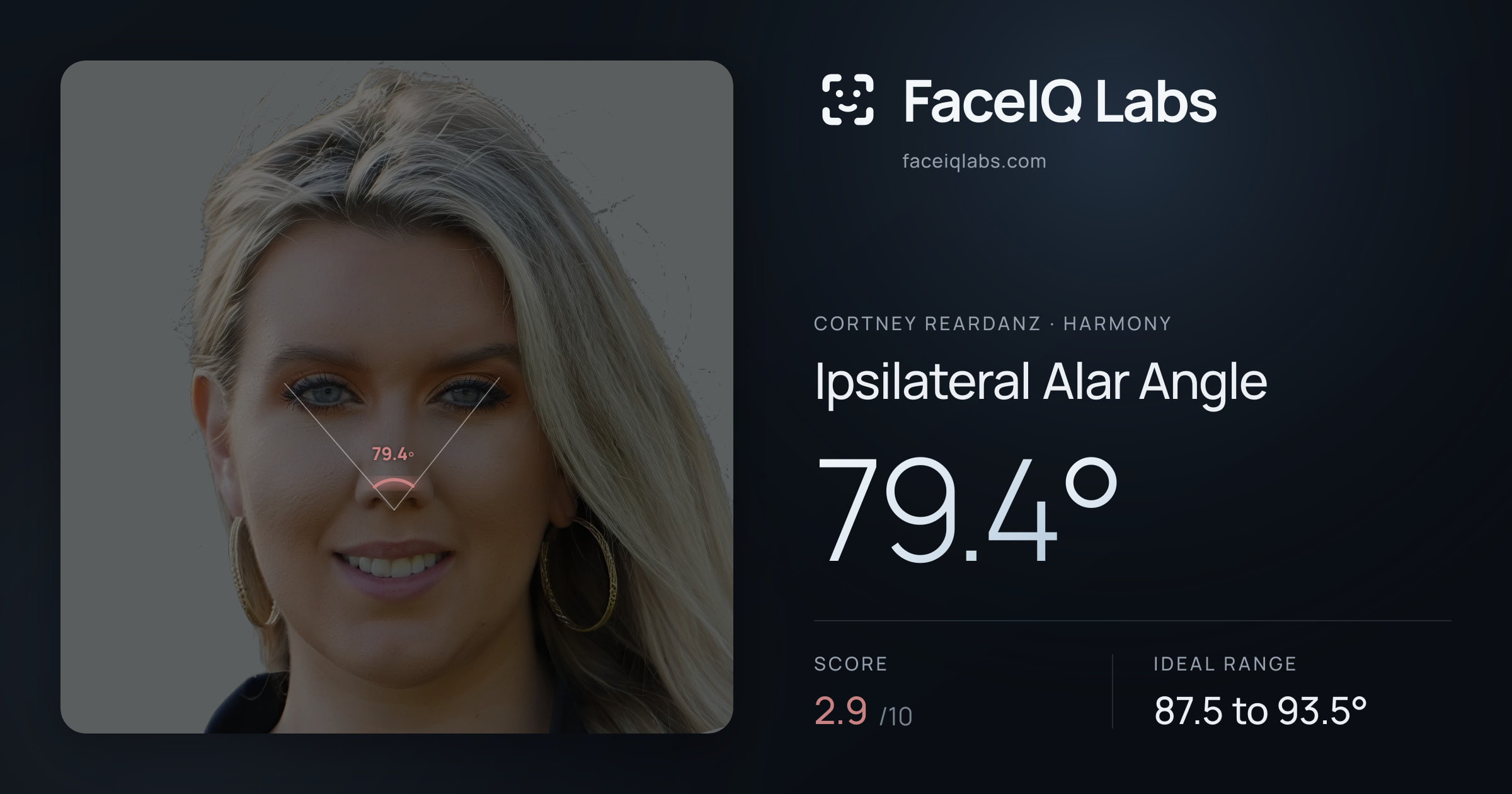 Cortney Reardanz Ipsilateral Alar Angle: 79.4°, drawn on the photo