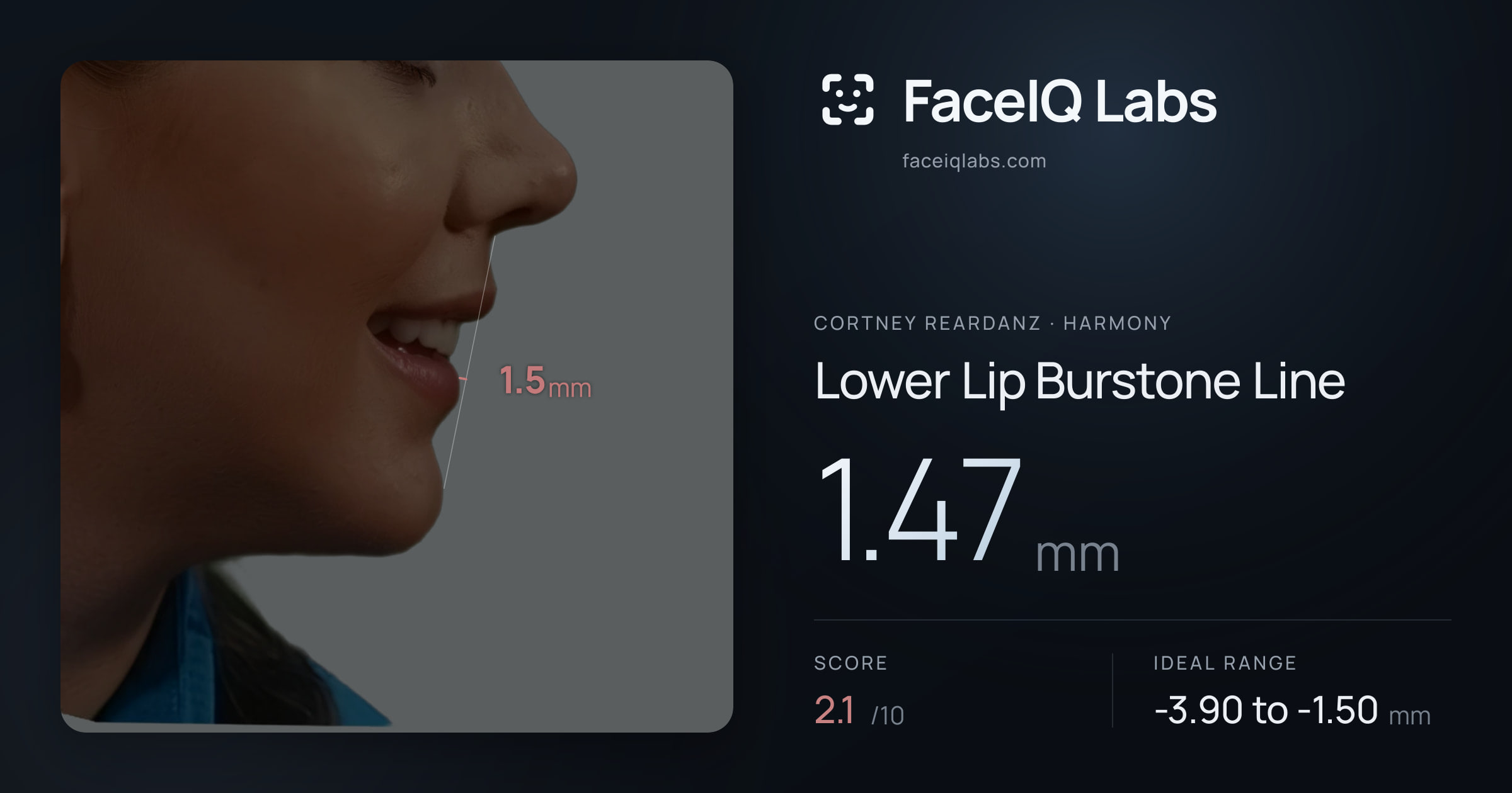 Cortney Reardanz Lower Lip Burstone Line: 1.47mm, drawn on the photo