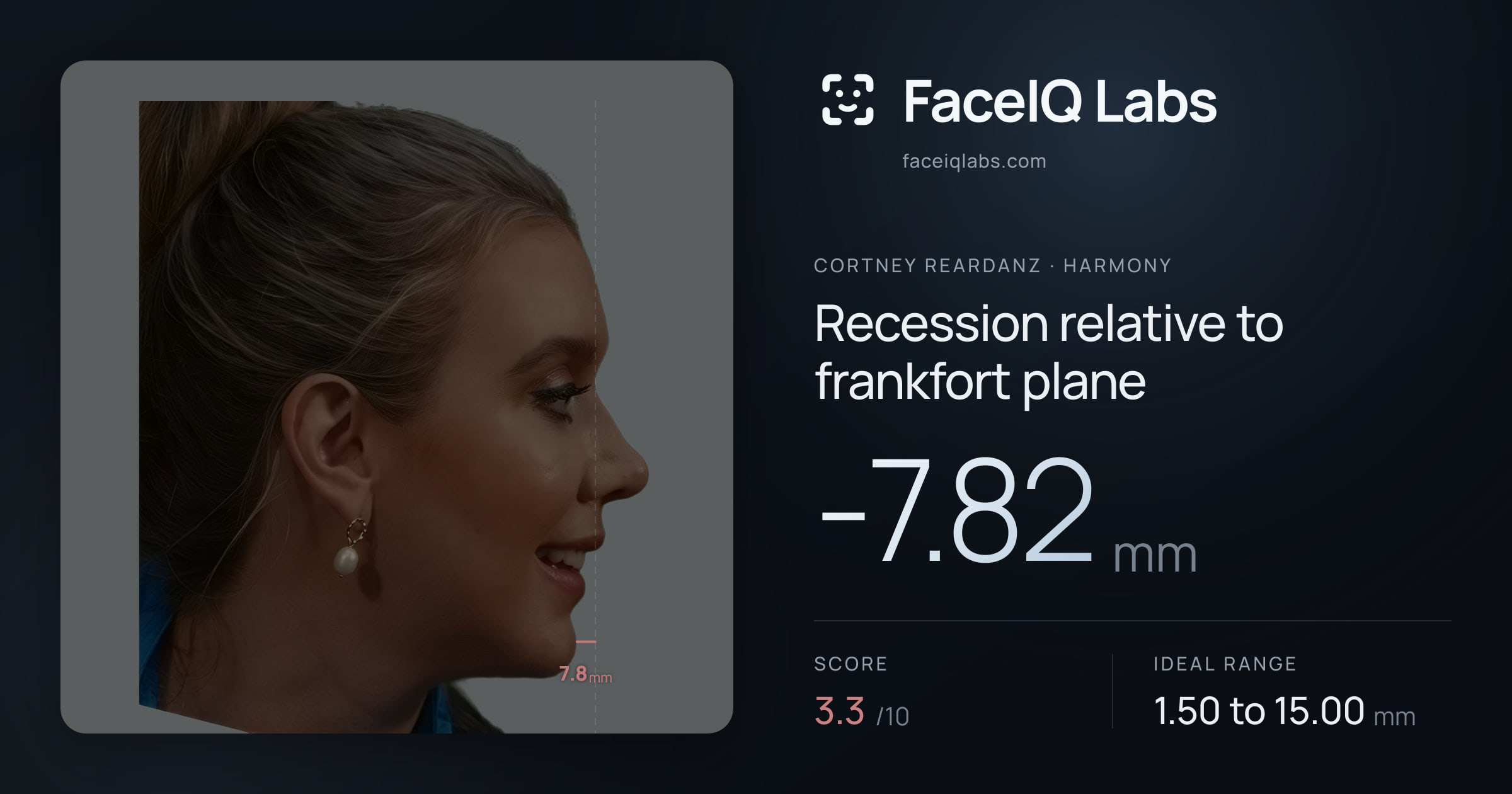 Cortney Reardanz Recession relative to frankfort plane: -7.82mm, drawn on the photo