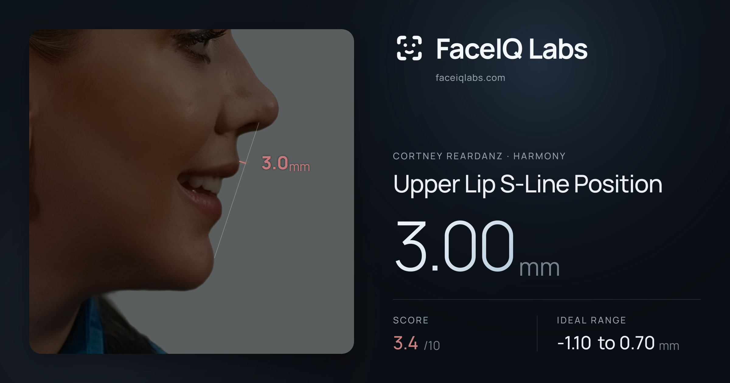 Cortney Reardanz Upper Lip S-Line Position: 3.00mm, drawn on the photo