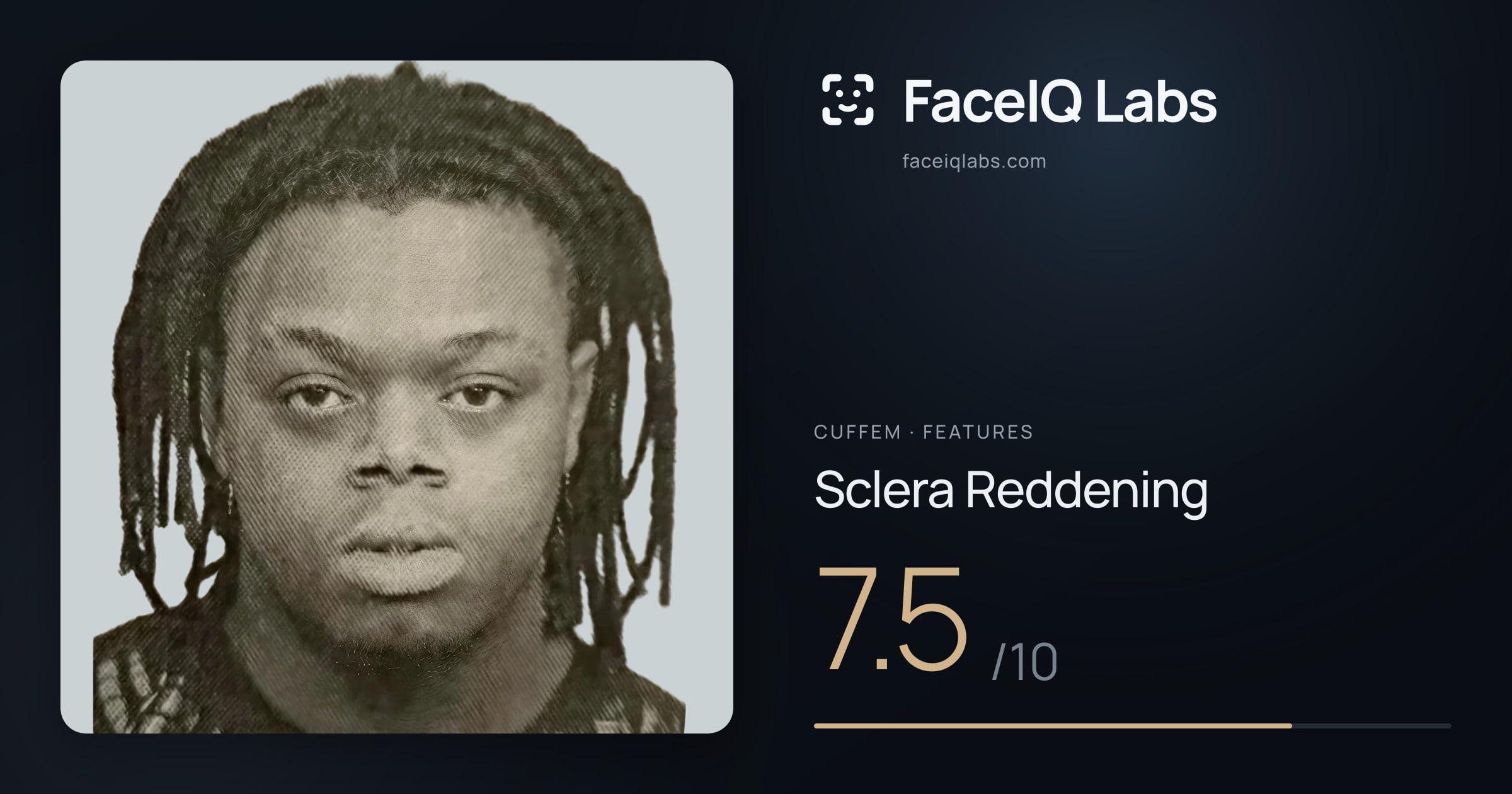 Cuffem Sclera Reddening: 7.5/10, drawn on the photo