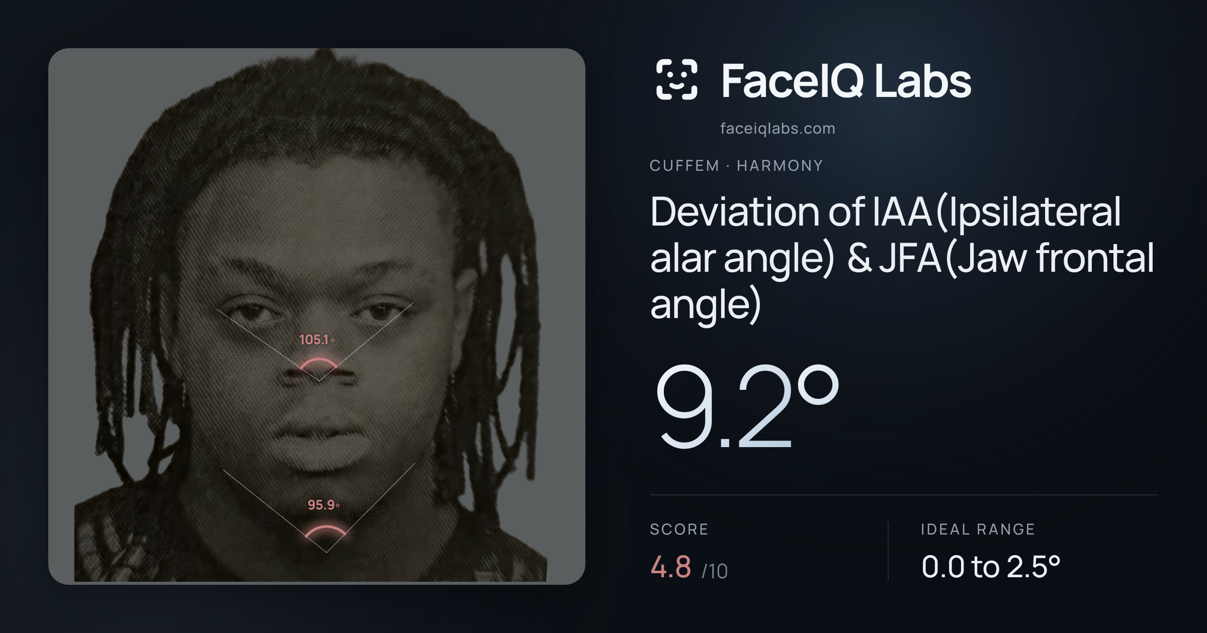 Cuffem Deviation of IAA(Ipsilateral alar angle) & JFA(Jaw frontal angle): 9.2°, drawn on the photo