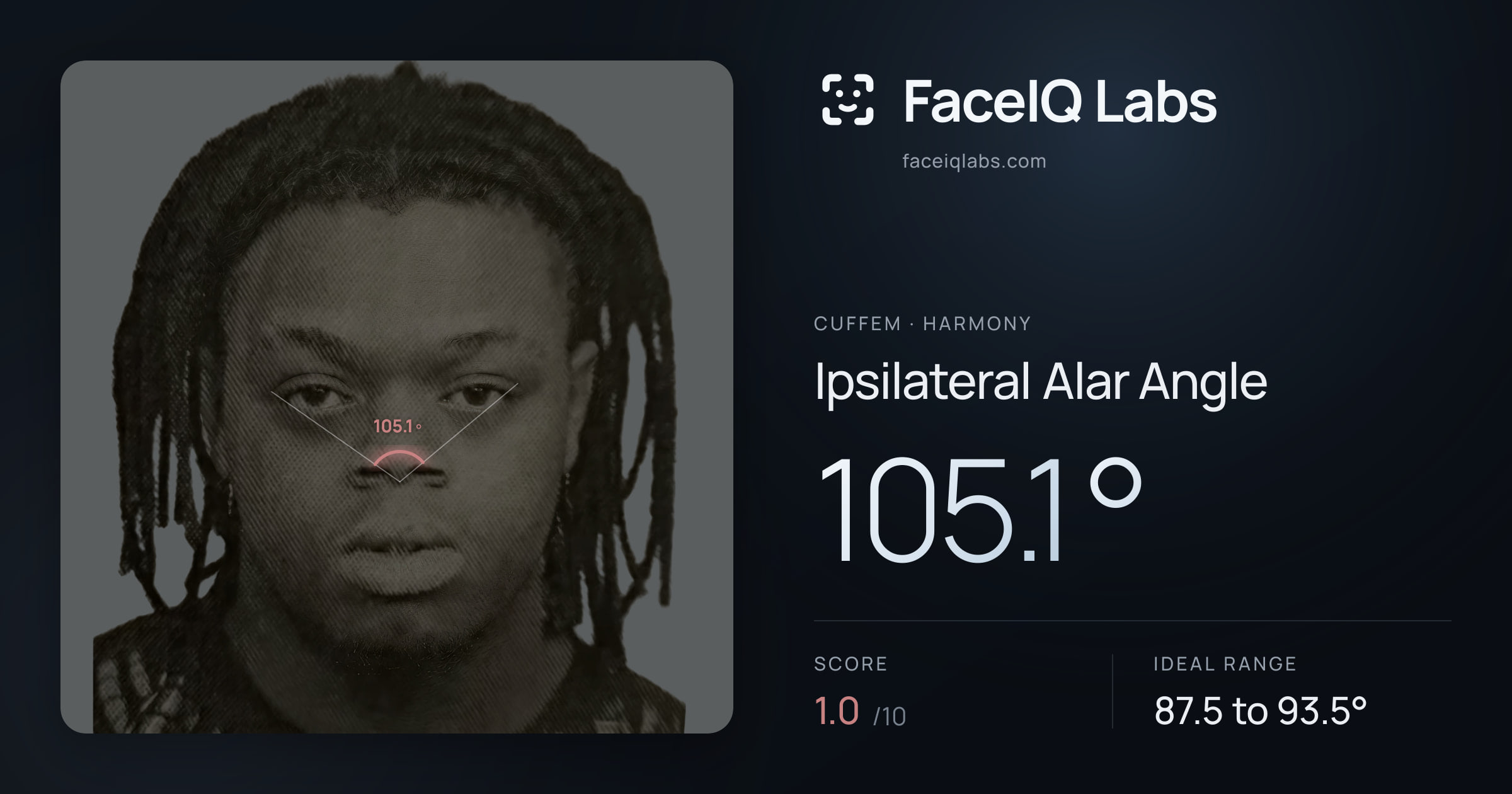 Cuffem Ipsilateral Alar Angle: 105.1°, drawn on the photo