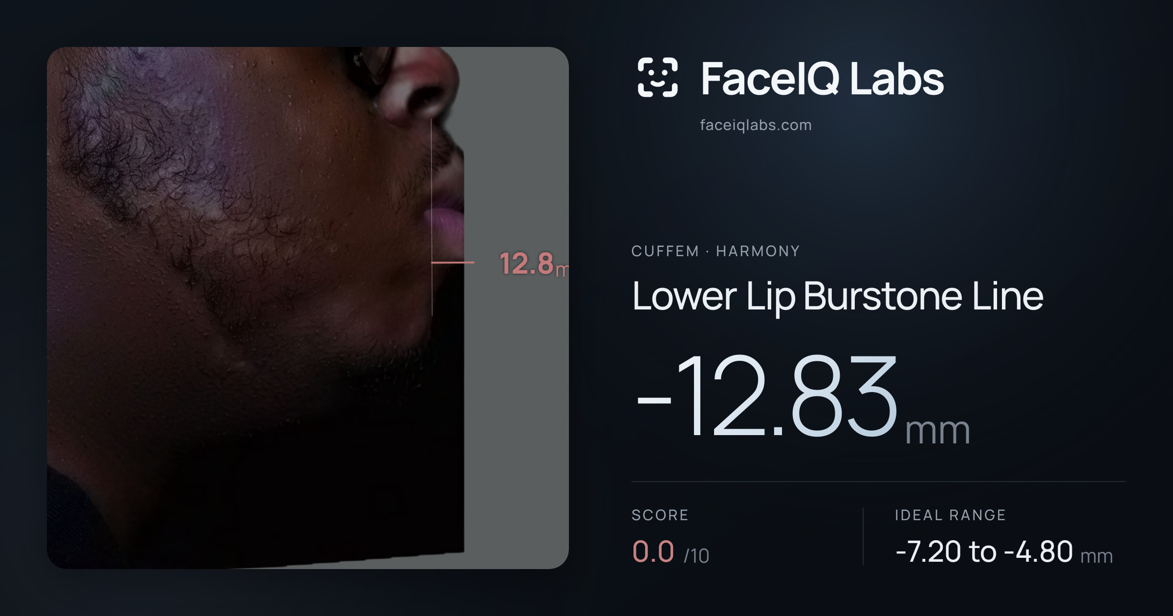 Cuffem Lower Lip Burstone Line: -12.83mm, drawn on the photo
