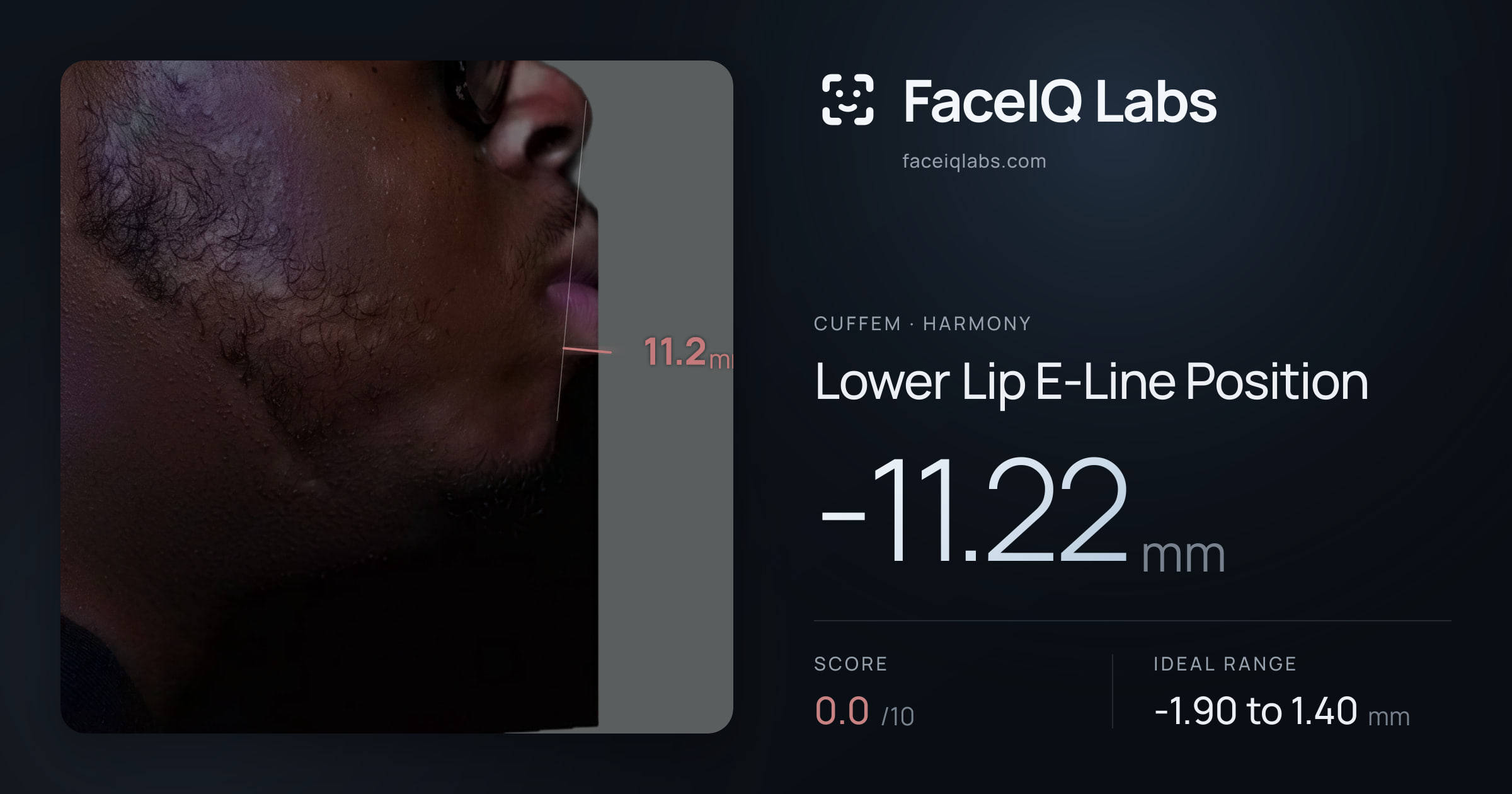 Cuffem Lower Lip E-Line Position: -11.22mm, drawn on the photo