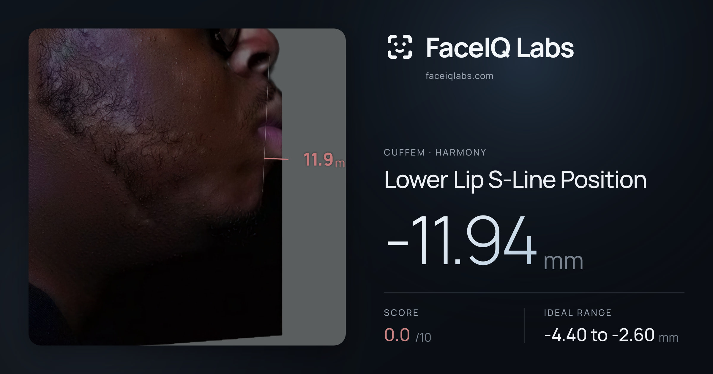 Cuffem Lower Lip S-Line Position: -11.94mm, drawn on the photo