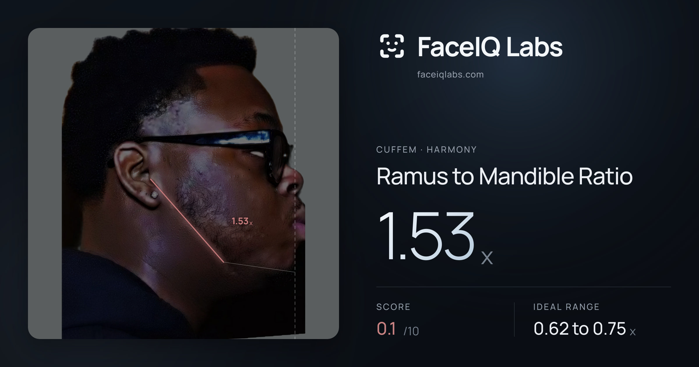 Cuffem Ramus to Mandible Ratio: 1.53x, drawn on the photo