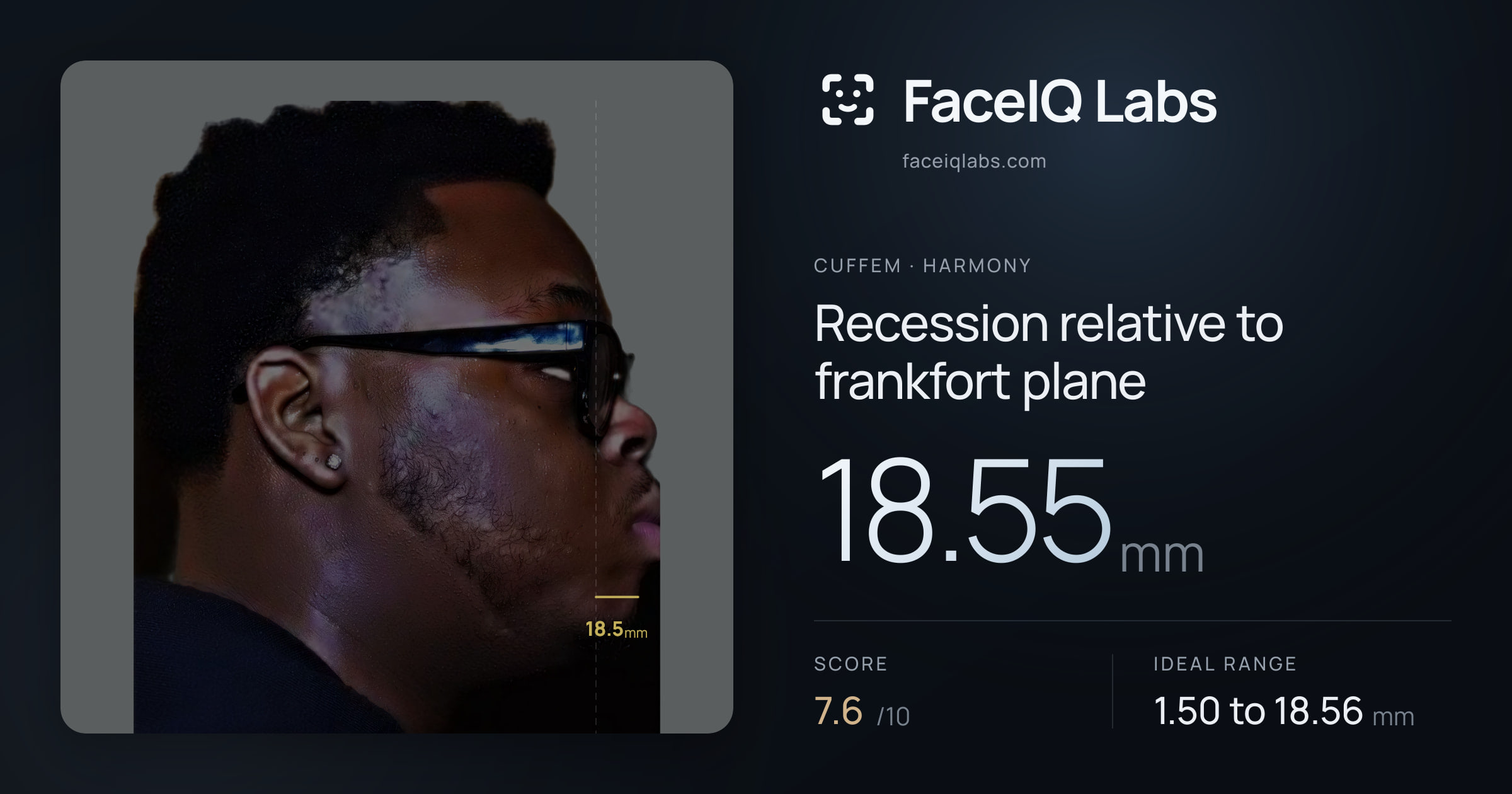 Cuffem Recession relative to frankfort plane: 18.55mm, drawn on the photo