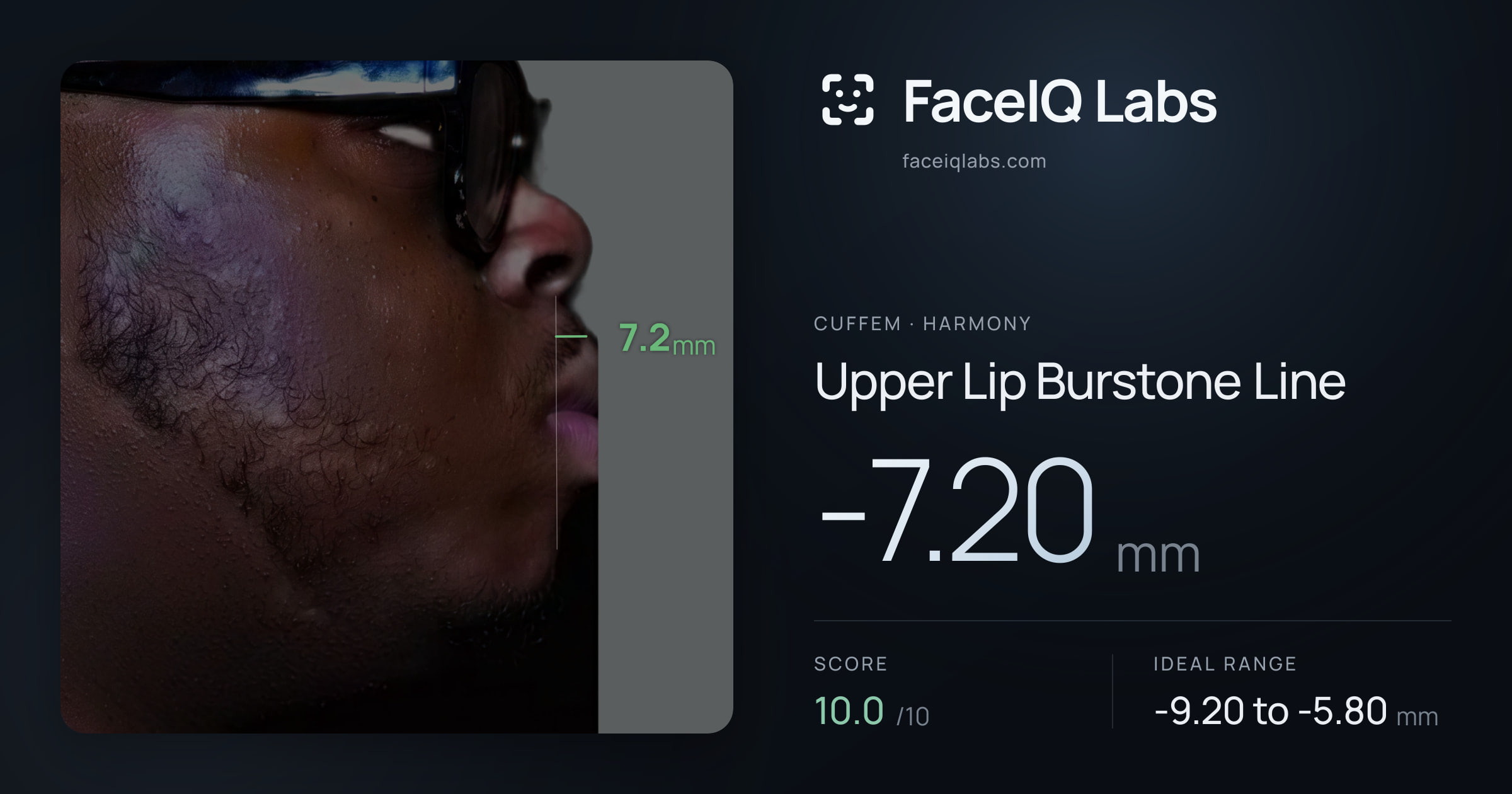 Cuffem Upper Lip Burstone Line: -7.20mm, drawn on the photo