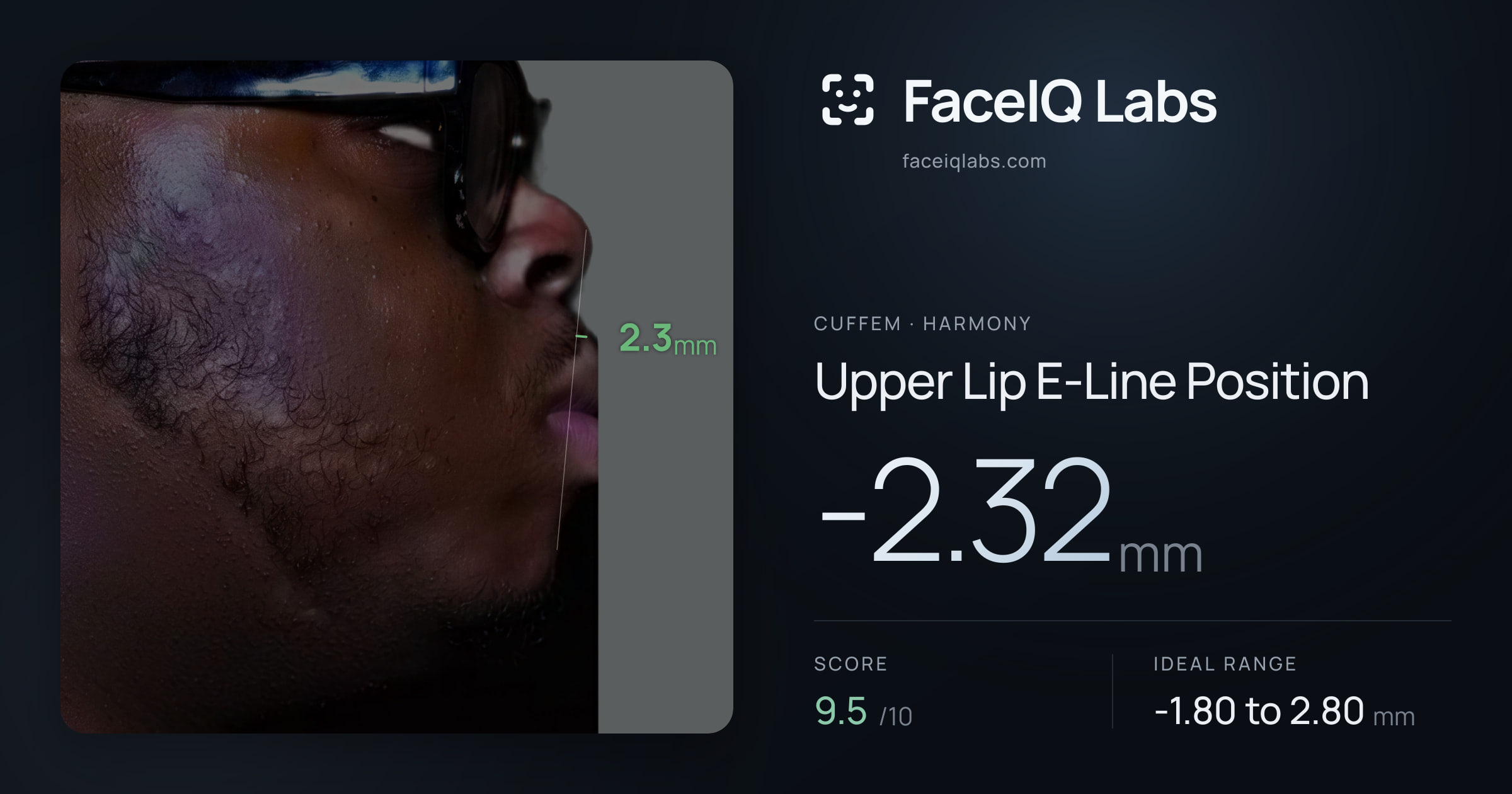 Cuffem Upper Lip E-Line Position: -2.32mm, drawn on the photo