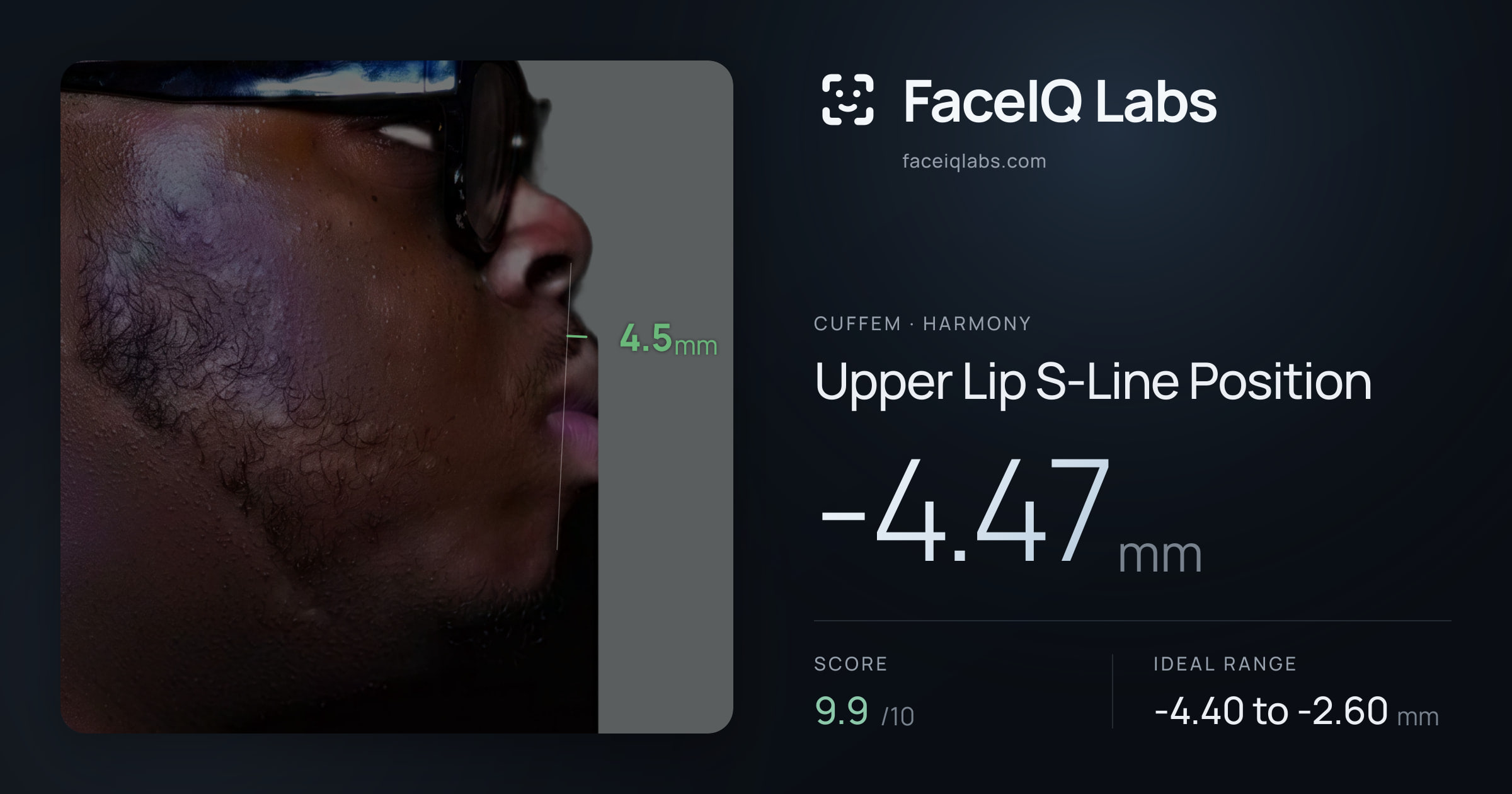 Cuffem Upper Lip S-Line Position: -4.47mm, drawn on the photo