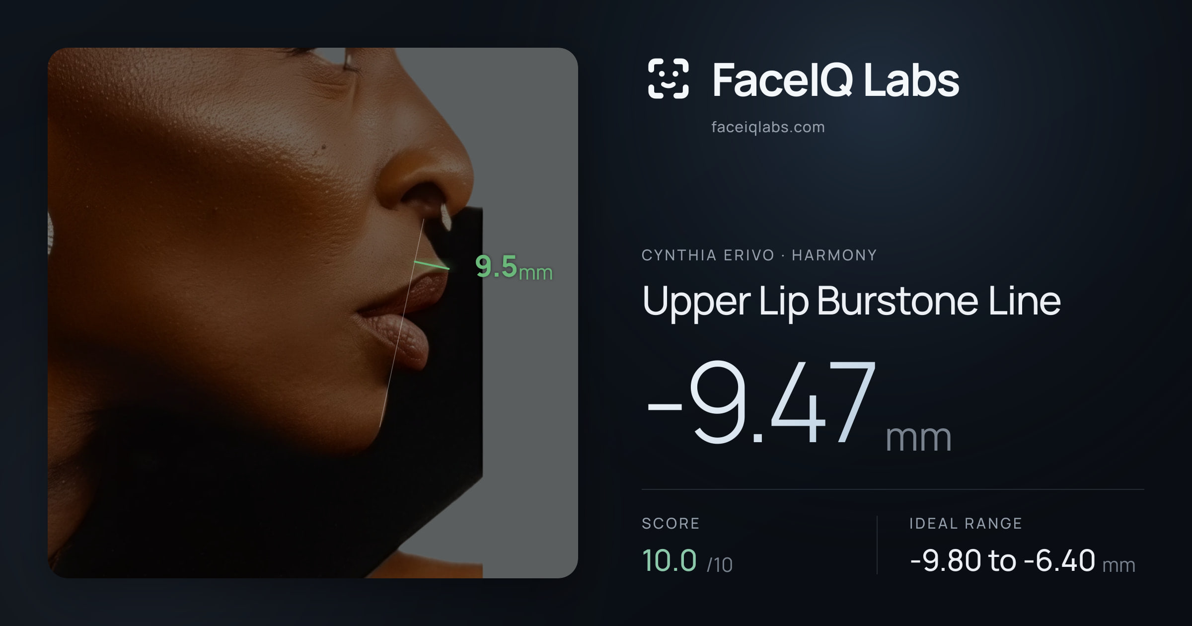 Cynthia Erivo Upper Lip Burstone Line: -9.47mm, drawn on the photo