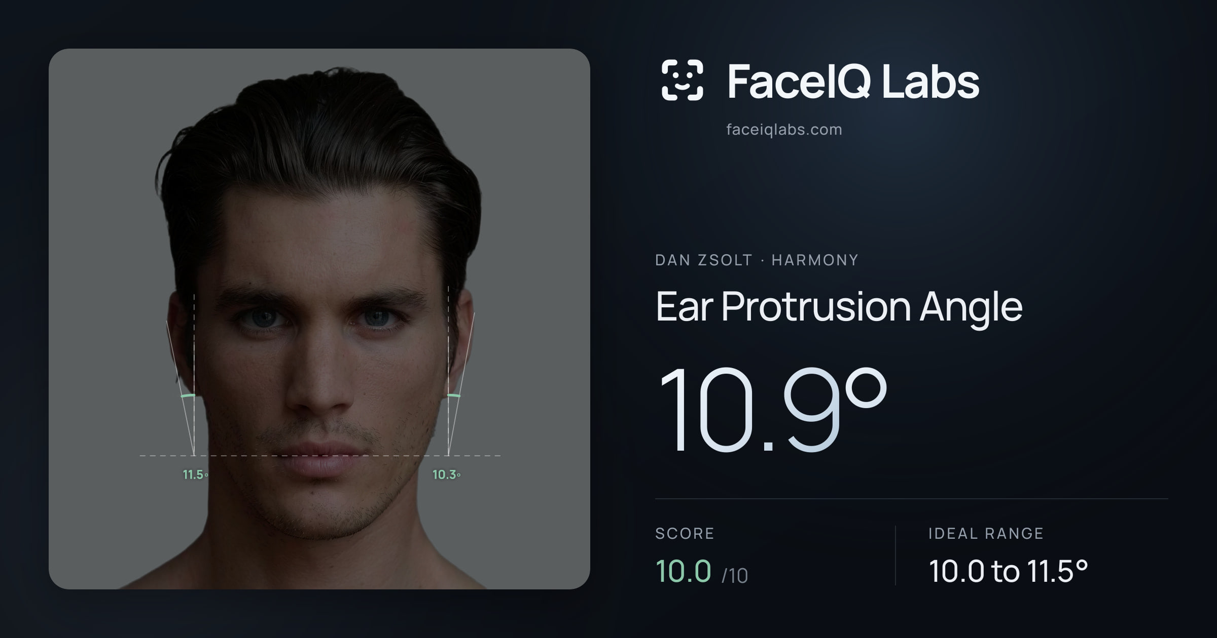 Dan Zsolt Ear Protrusion Angle: 10.9°, drawn on the photo