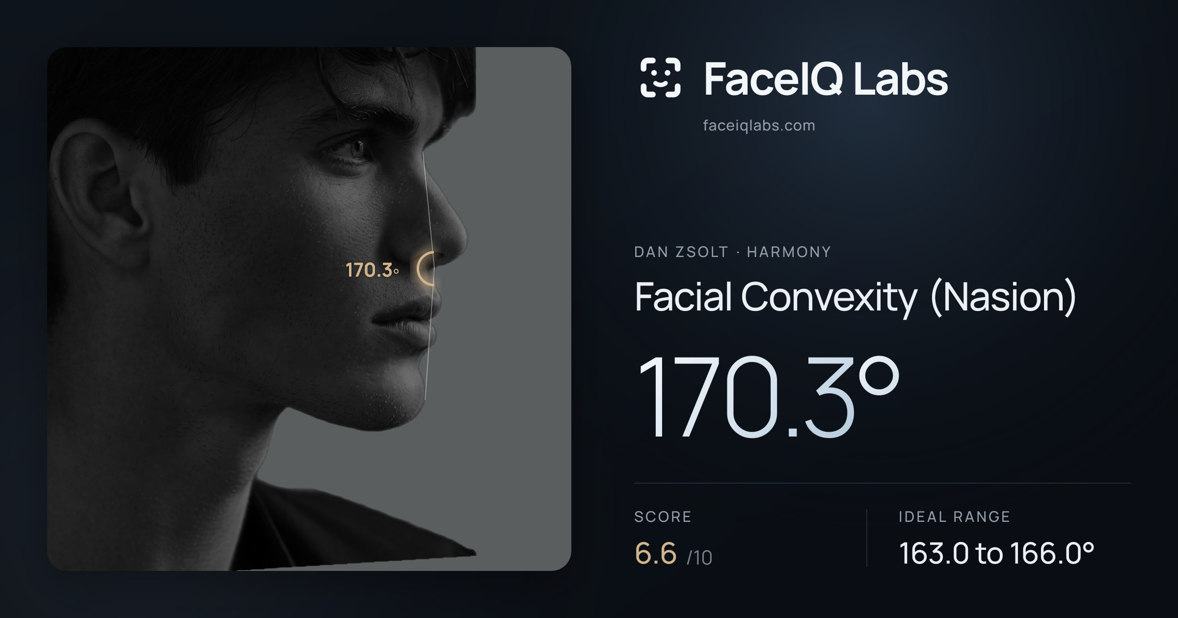 Dan Zsolt Facial Convexity (Nasion): 170.3°, drawn on the photo