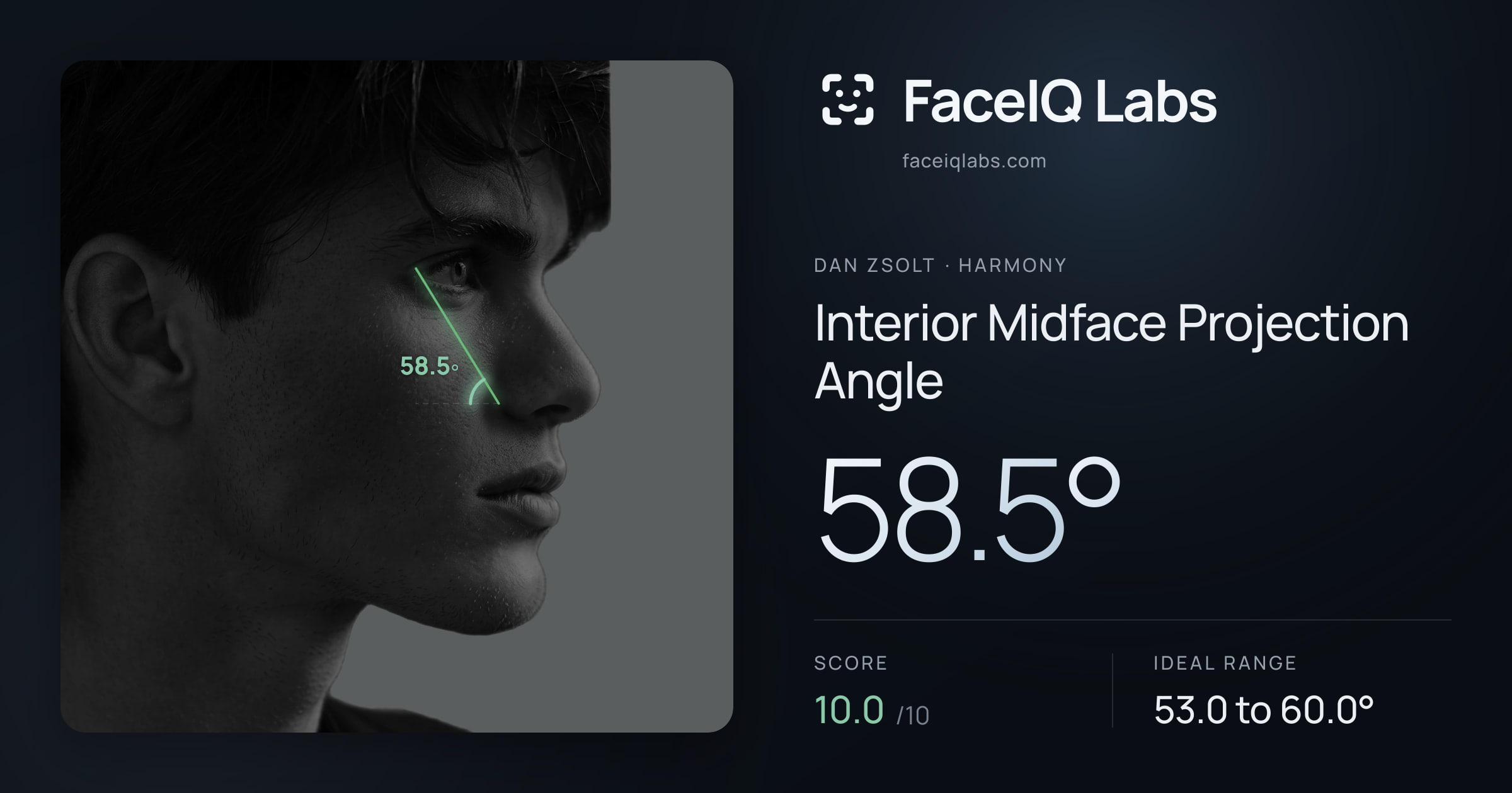 Dan Zsolt Interior Midface Projection Angle: 58.5°, drawn on the photo