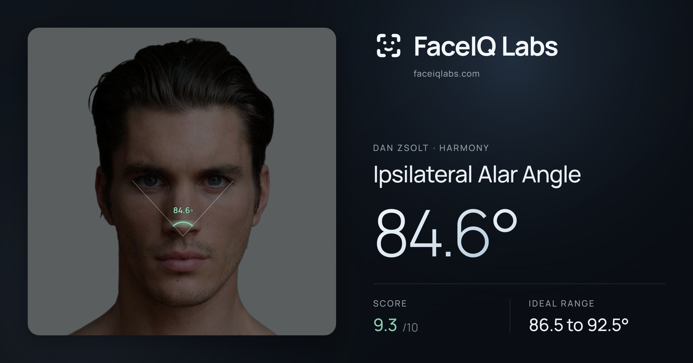 Dan Zsolt Ipsilateral Alar Angle: 84.6°, drawn on the photo