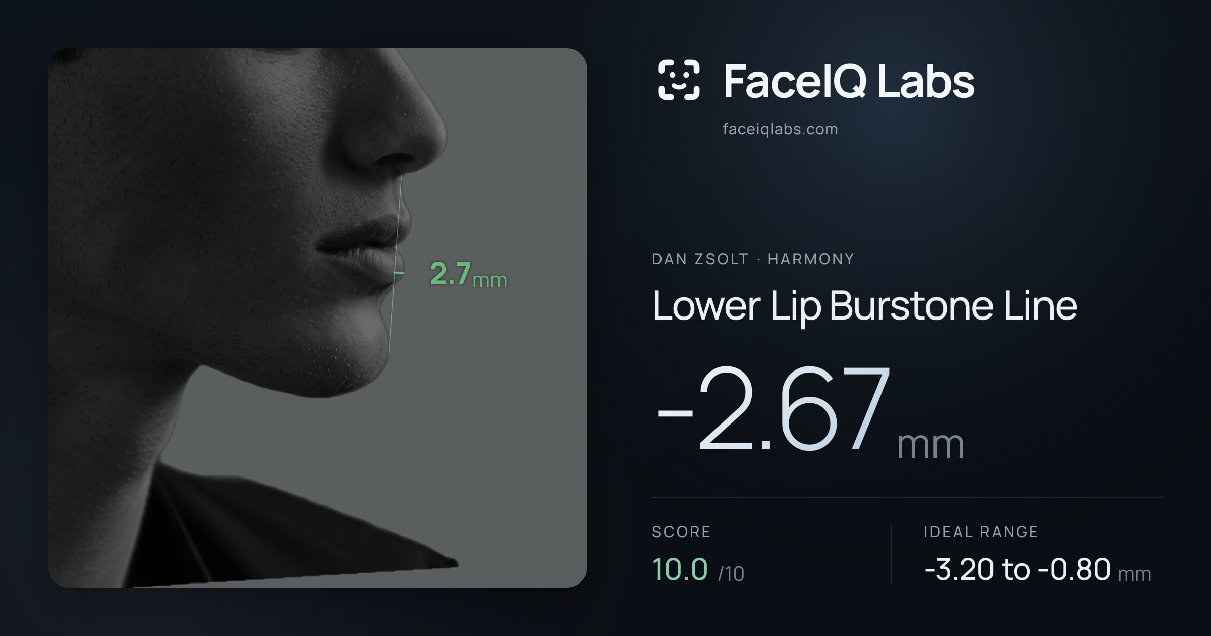 Dan Zsolt Lower Lip Burstone Line: -2.67mm, drawn on the photo