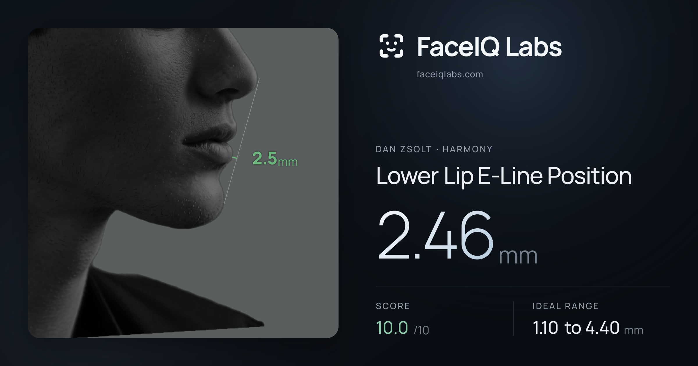 Dan Zsolt Lower Lip E-Line Position: 2.46mm, drawn on the photo