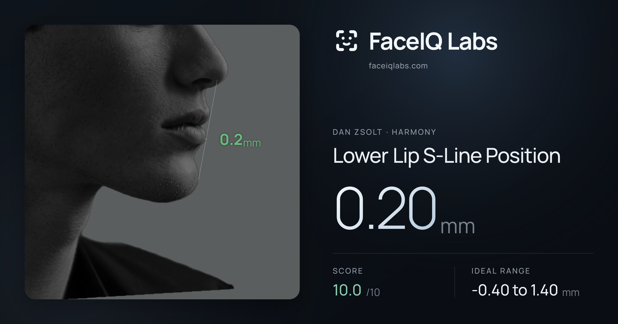 Dan Zsolt Lower Lip S-Line Position: 0.20mm, drawn on the photo
