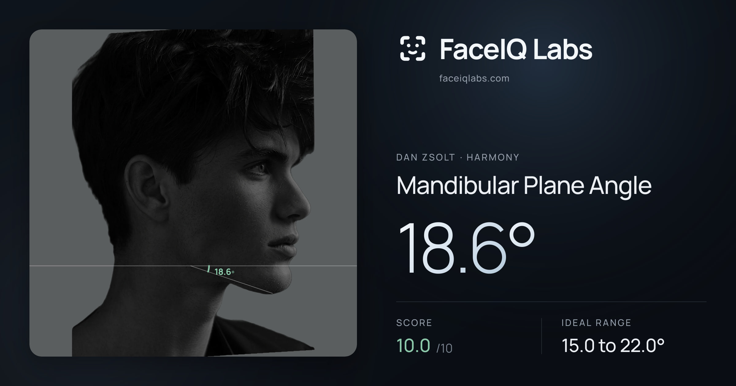 Dan Zsolt Mandibular Plane Angle: 18.6°, drawn on the photo