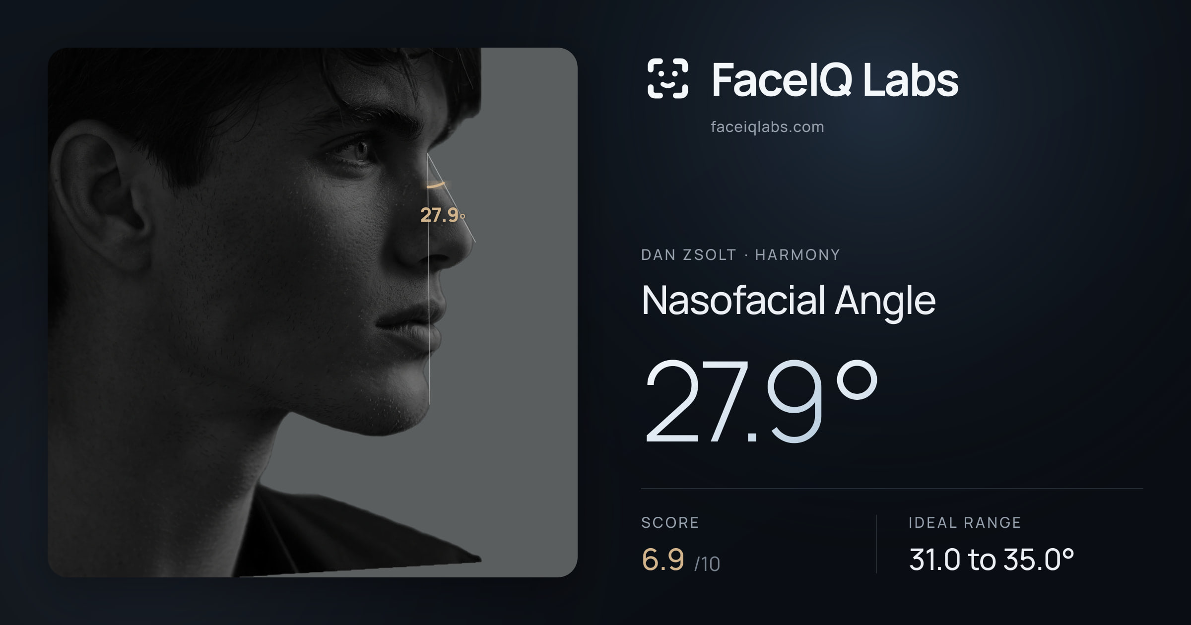 Dan Zsolt Nasofacial Angle: 27.9°, drawn on the photo