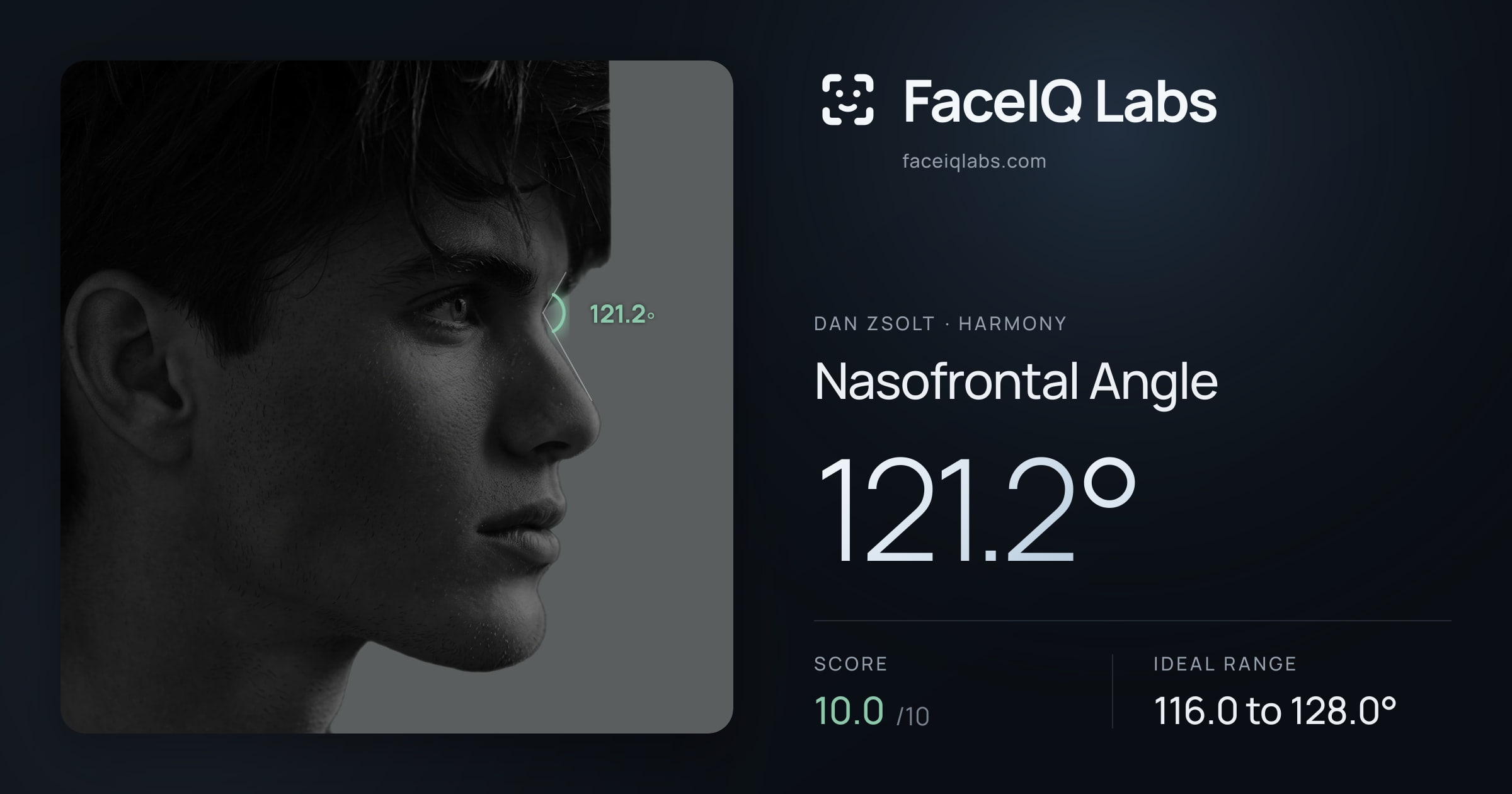 Dan Zsolt Nasofrontal Angle: 121.2°, drawn on the photo