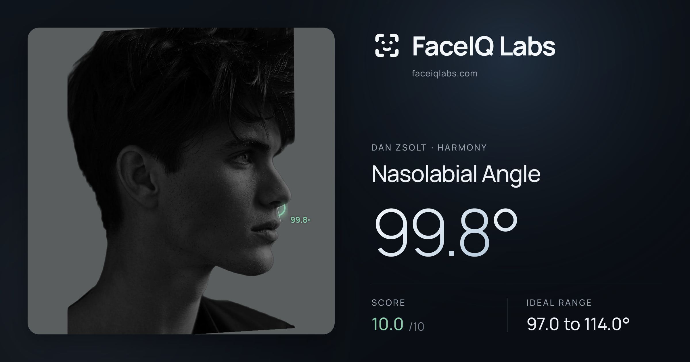 Dan Zsolt Nasolabial Angle: 99.8°, drawn on the photo
