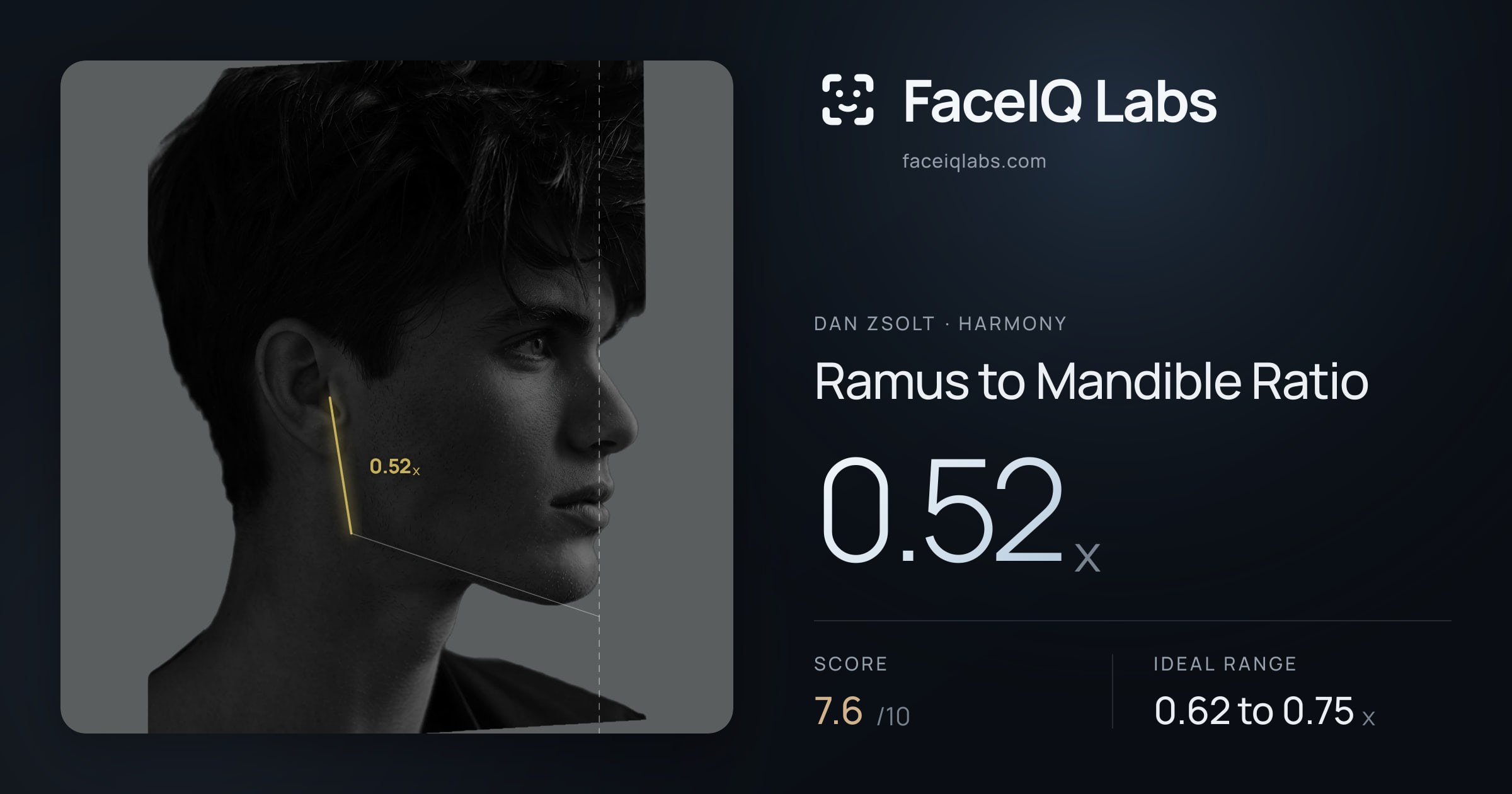 Dan Zsolt Ramus to Mandible Ratio: 0.52x, drawn on the photo
