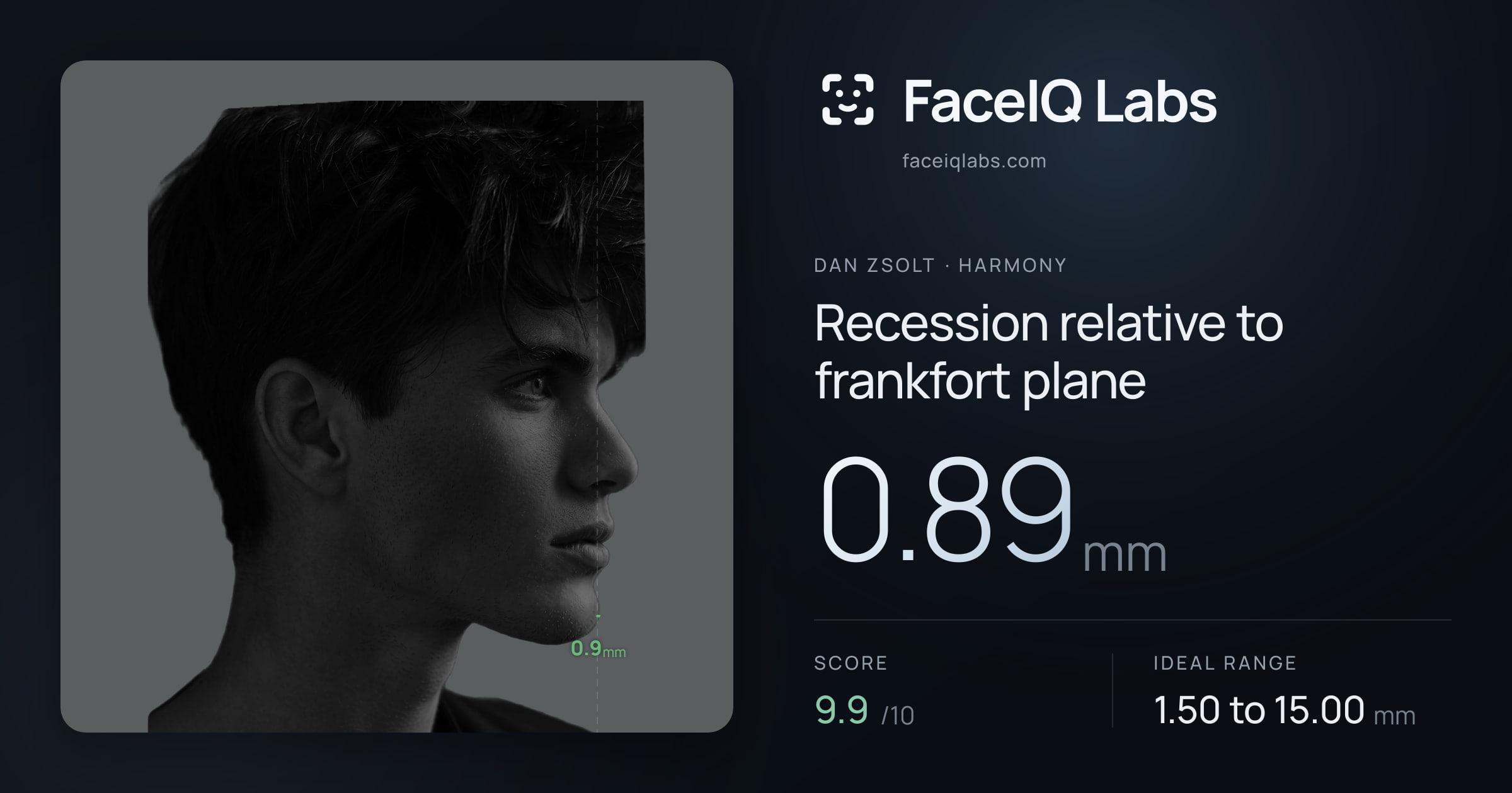 Dan Zsolt Recession relative to frankfort plane: 0.89mm, drawn on the photo