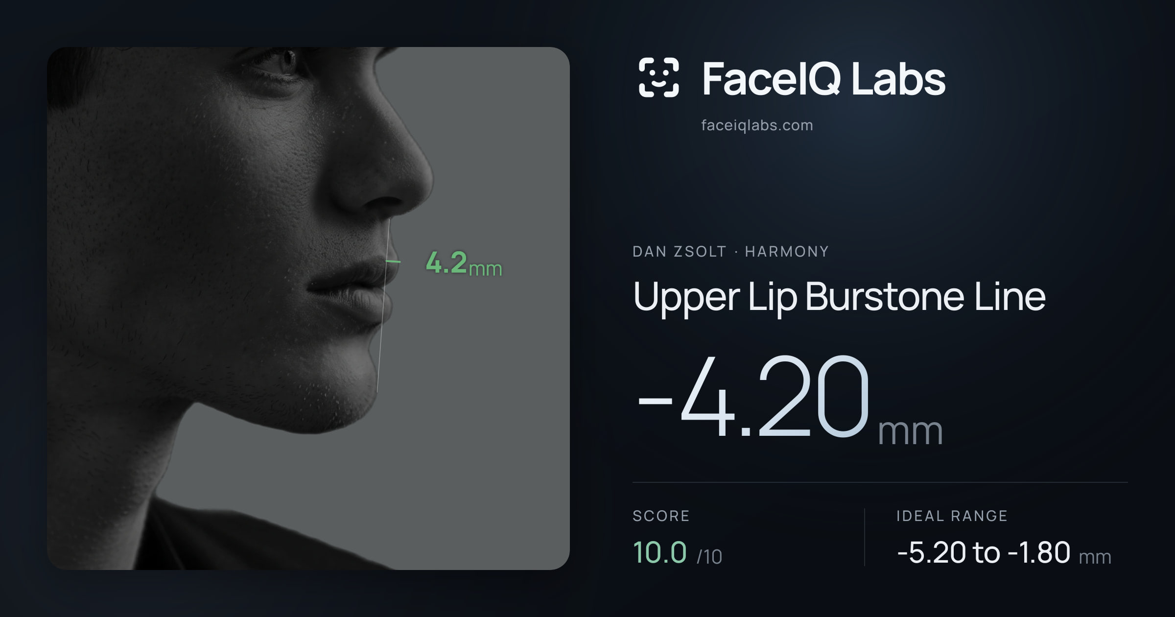 Dan Zsolt Upper Lip Burstone Line: -4.20mm, drawn on the photo