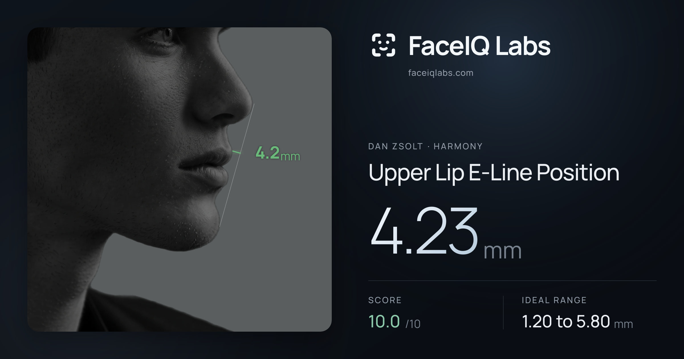 Dan Zsolt Upper Lip E-Line Position: 4.23mm, drawn on the photo