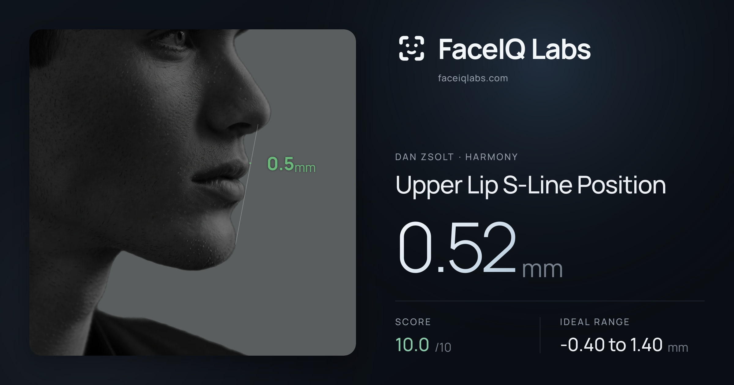 Dan Zsolt Upper Lip S-Line Position: 0.52mm, drawn on the photo