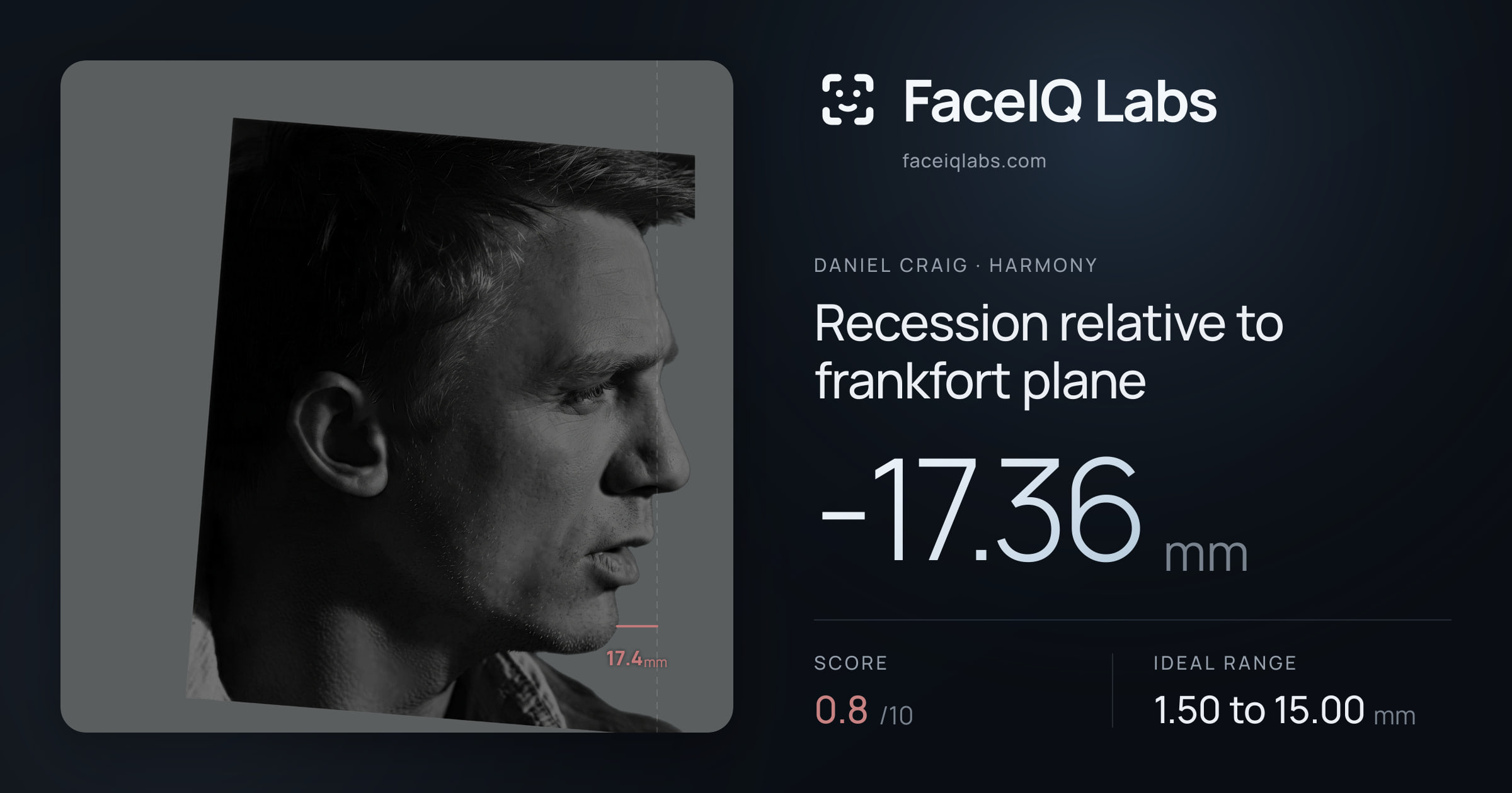 Daniel Craig Recession relative to frankfort plane: -17.36mm, drawn on the photo