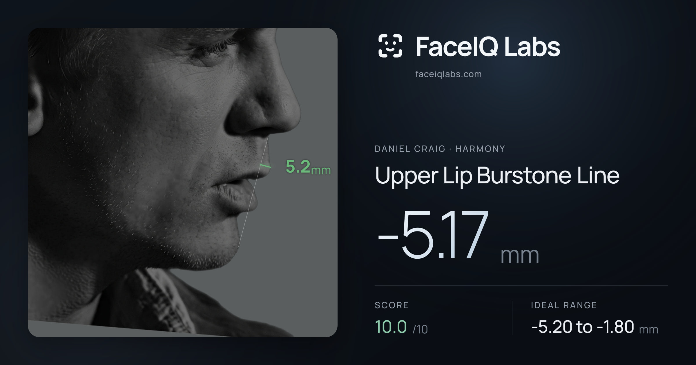 Daniel Craig Upper Lip Burstone Line: -5.17mm, drawn on the photo