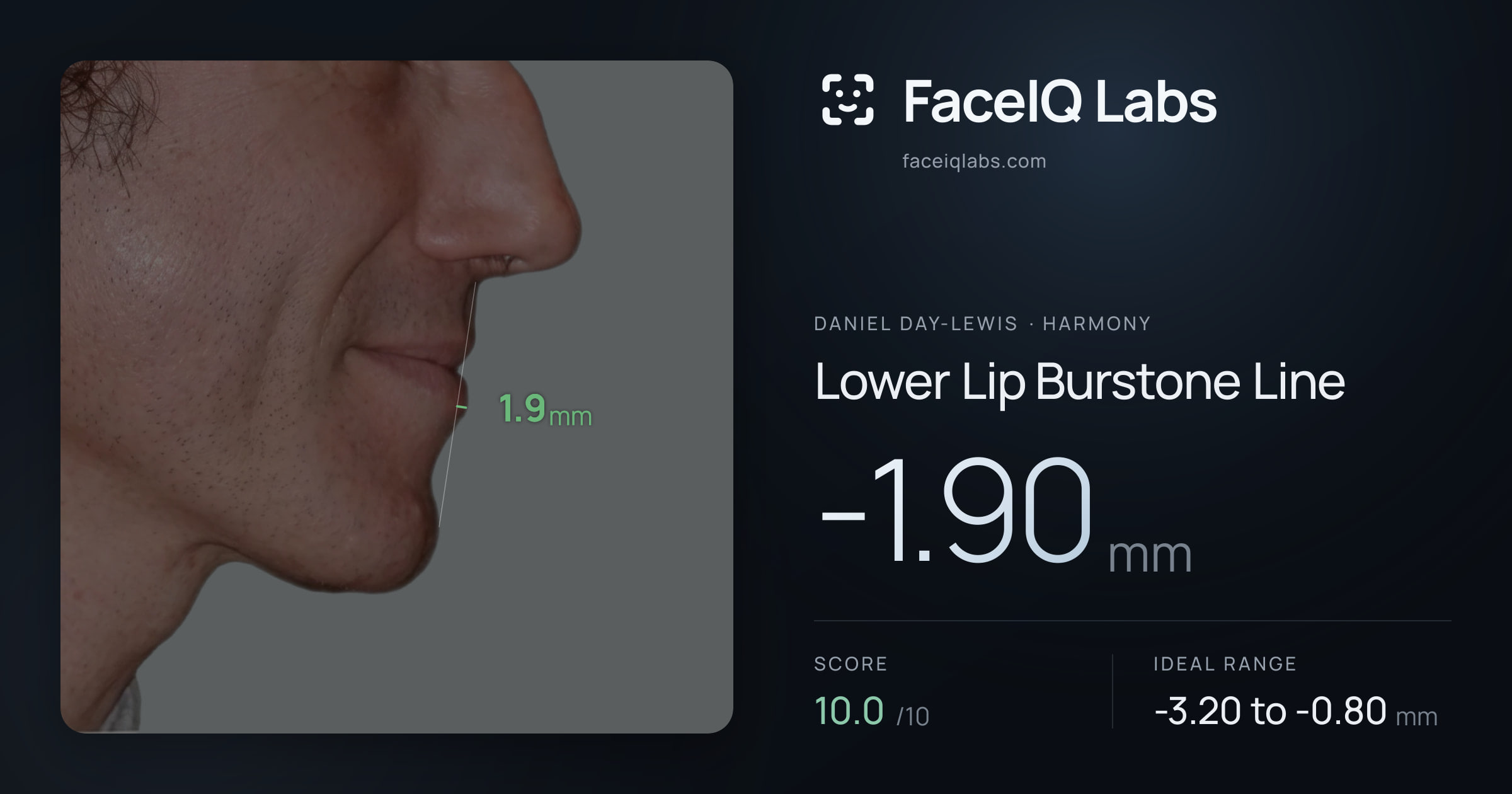 Daniel Day-Lewis Lower Lip Burstone Line: -1.90mm, drawn on the photo