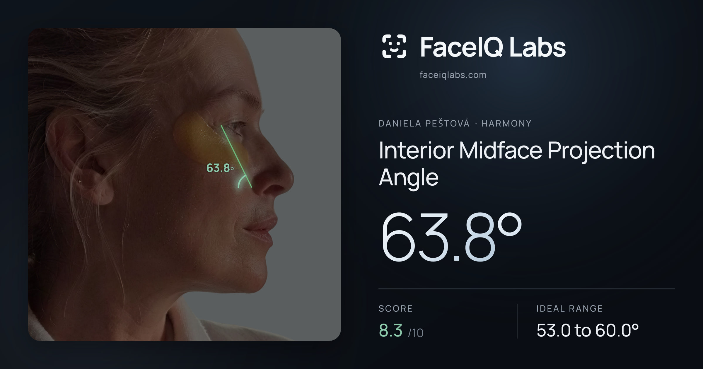 Daniela Peštová Interior Midface Projection Angle: 63.8°, drawn on the photo