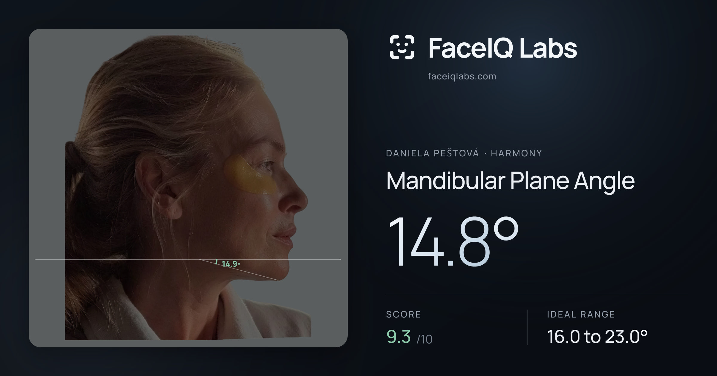 Daniela Peštová Mandibular Plane Angle: 14.8°, drawn on the photo